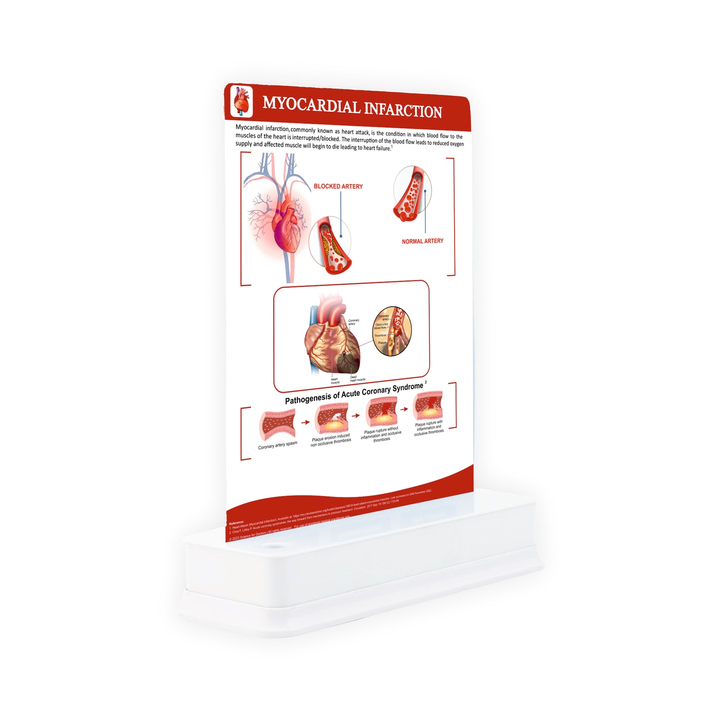 Myocardial Infarction: 1 Slide on stand