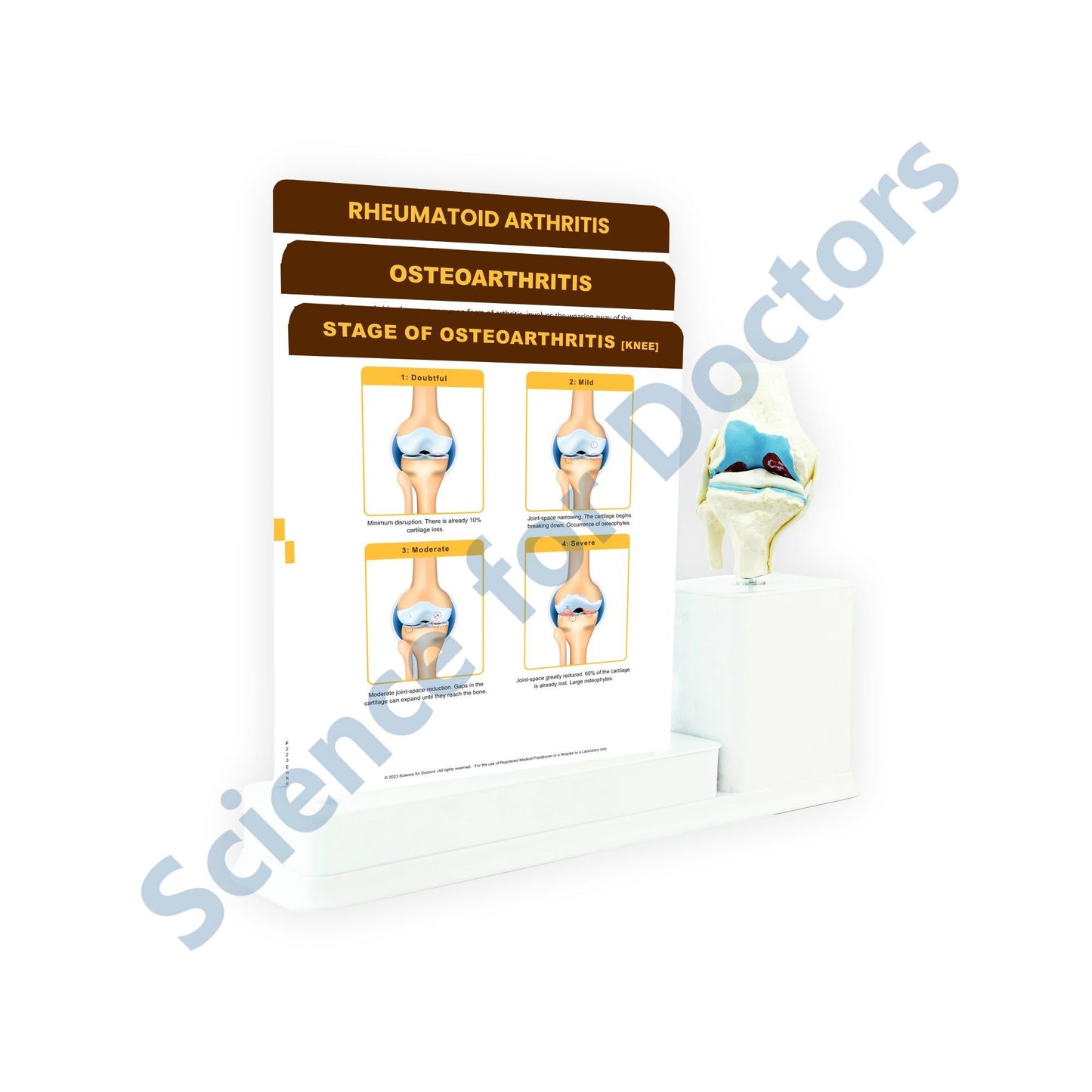 STAGE OF OSTEOARTHRITIS [KNEE]: 3 Slide Write and Wipe with Anatomical Model on Stand