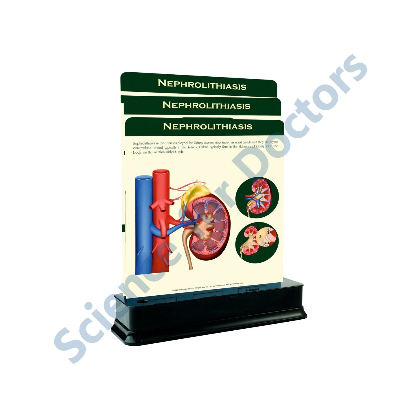 Nephrolithiasis: 3 Slides on stand