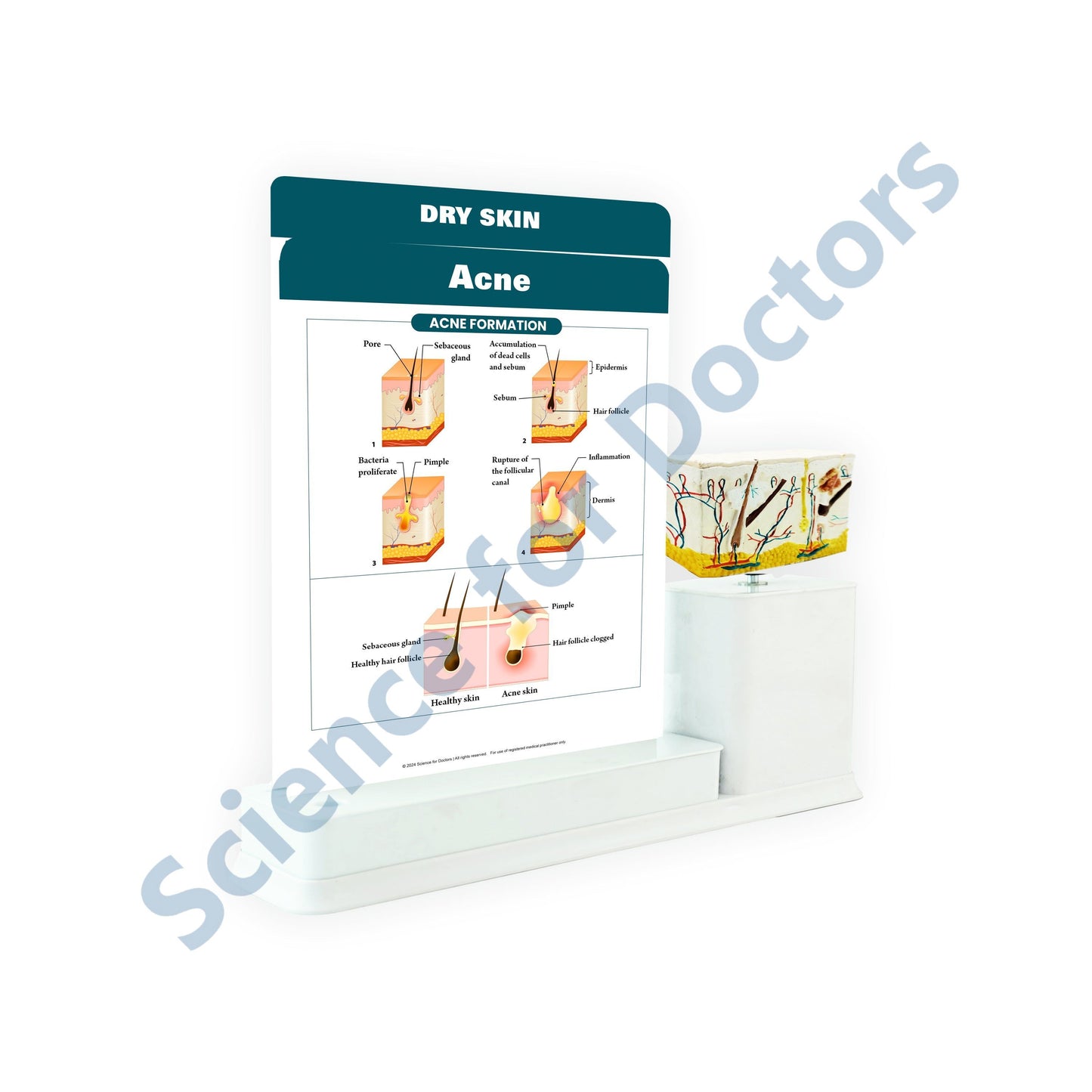 Acne: 2 Slides Write and Wipe with Anatomical Model On Stand