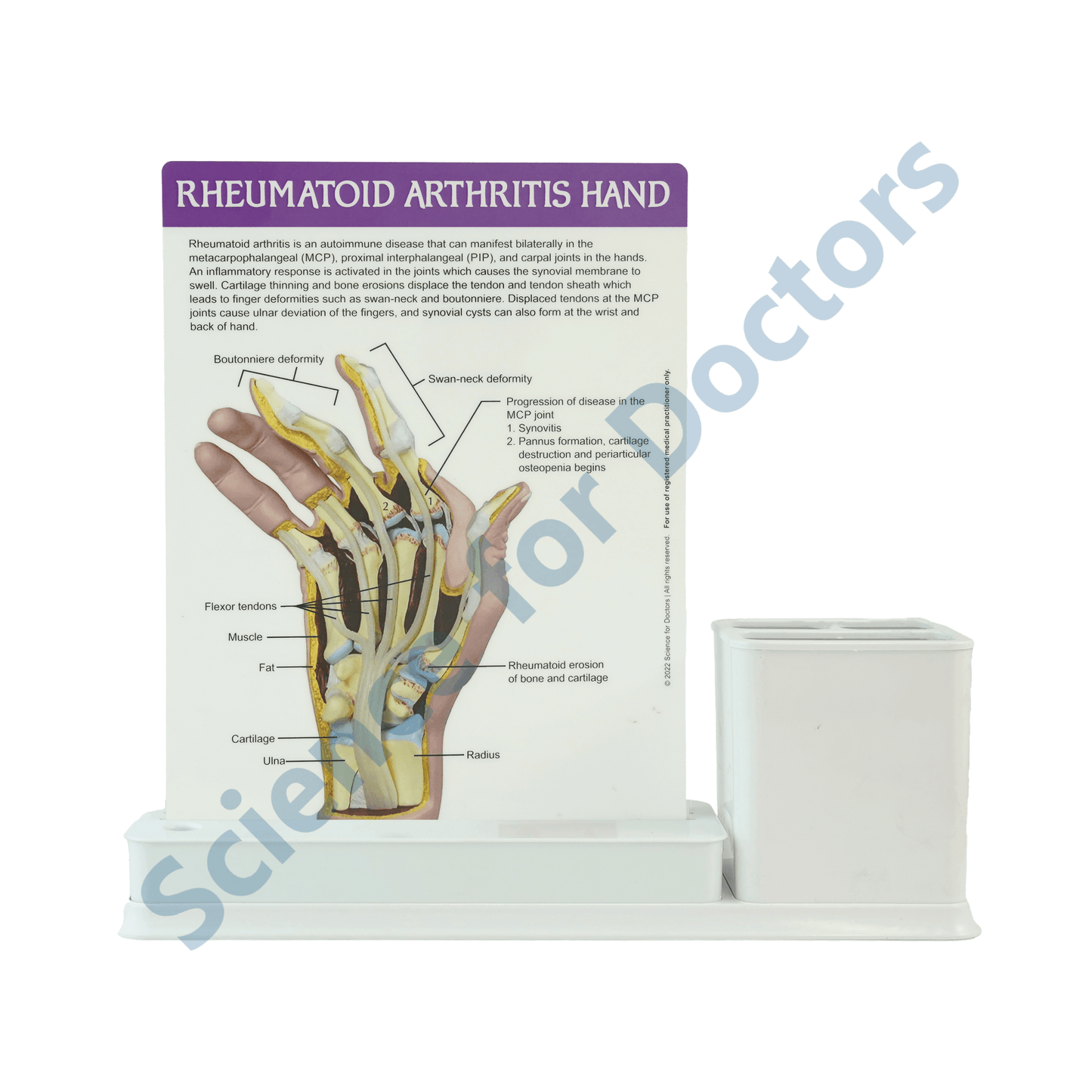 Rheumatoid Arthritis Hand: 1 Slides Write & Wipe with Stationary Stand