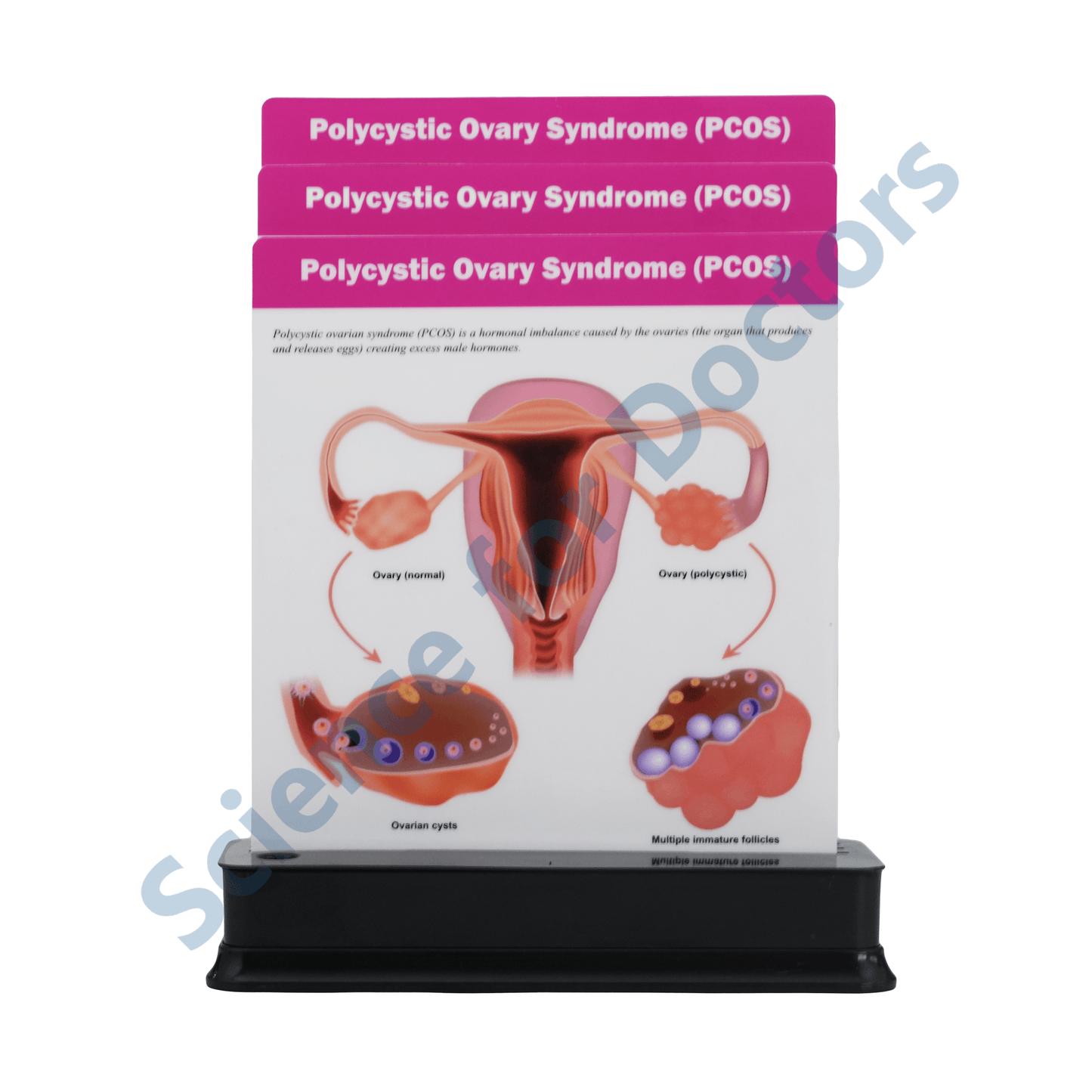 PCOS( Polycystic Ovary Syndrome): 3 slide on stand