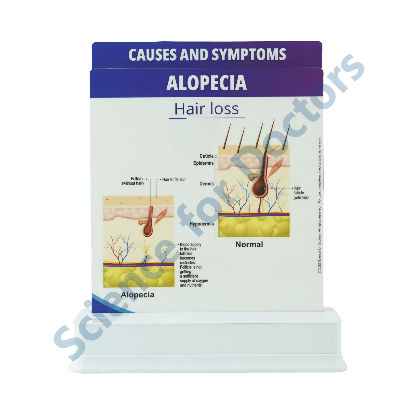 Alopecia: 2 slide on stand