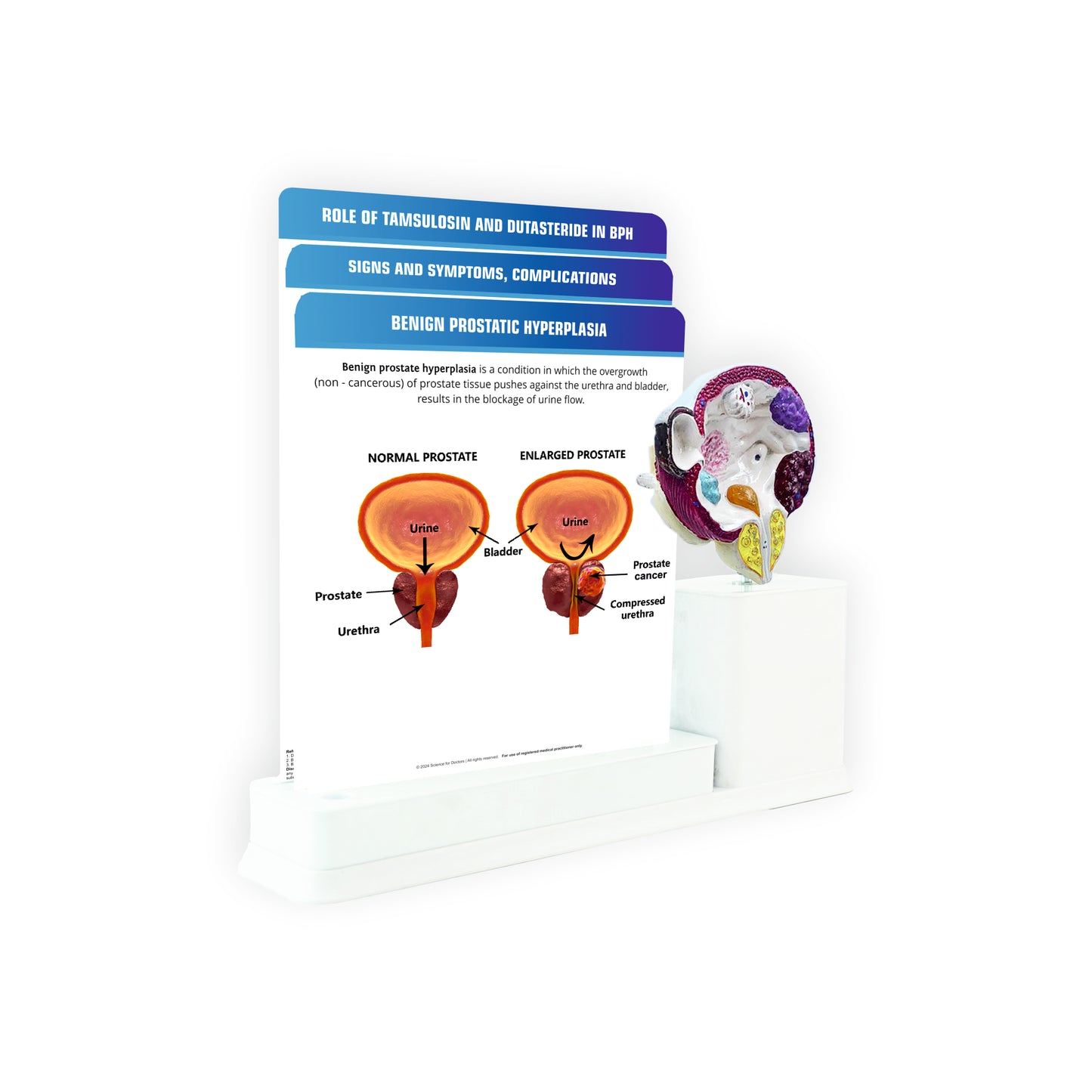 Benign Prostatic Hyperplasia_1 : 3 Slides Write & Wipe With Model On Stand