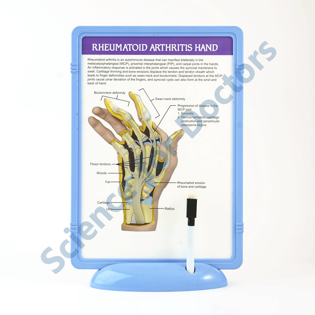 Rheumatoid Arthritis Hand: The Frame Write and Wipe