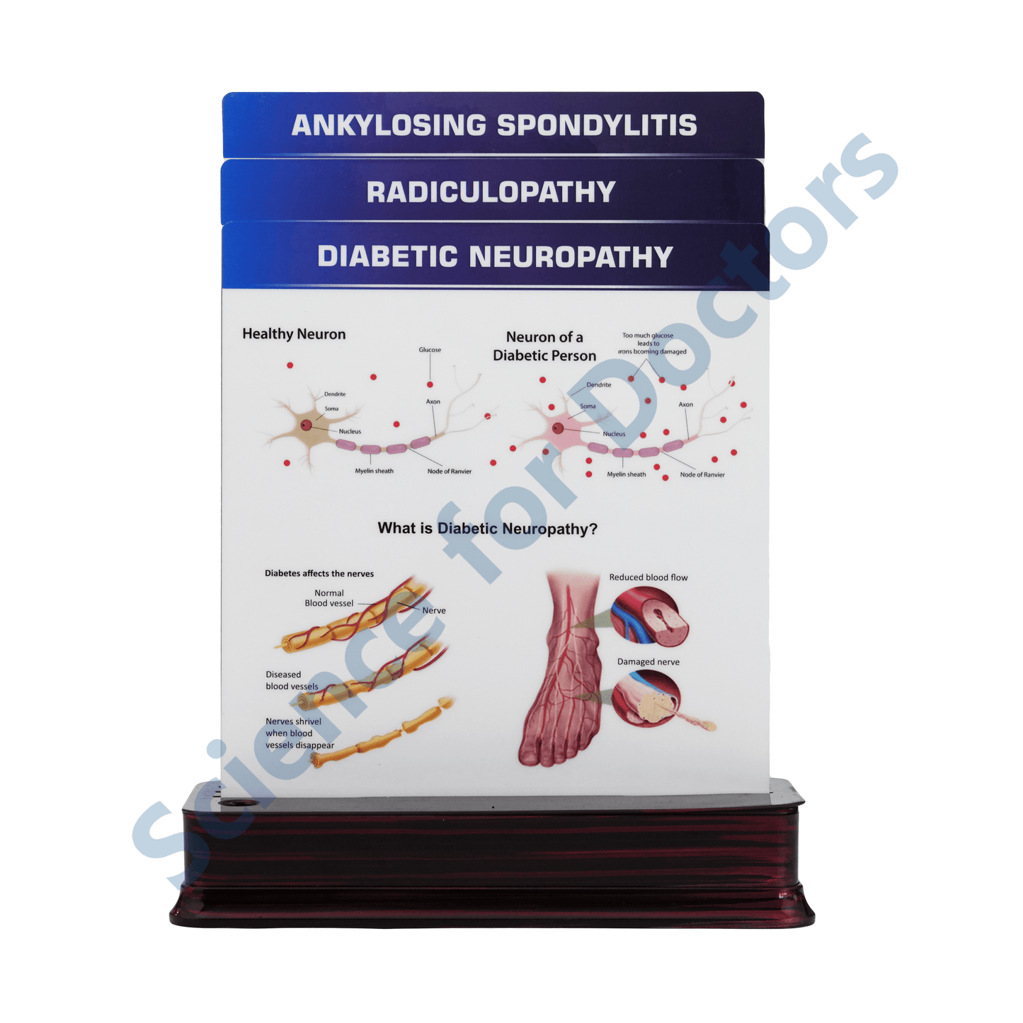 Diabetic Neuropathy: 3 slide on stand