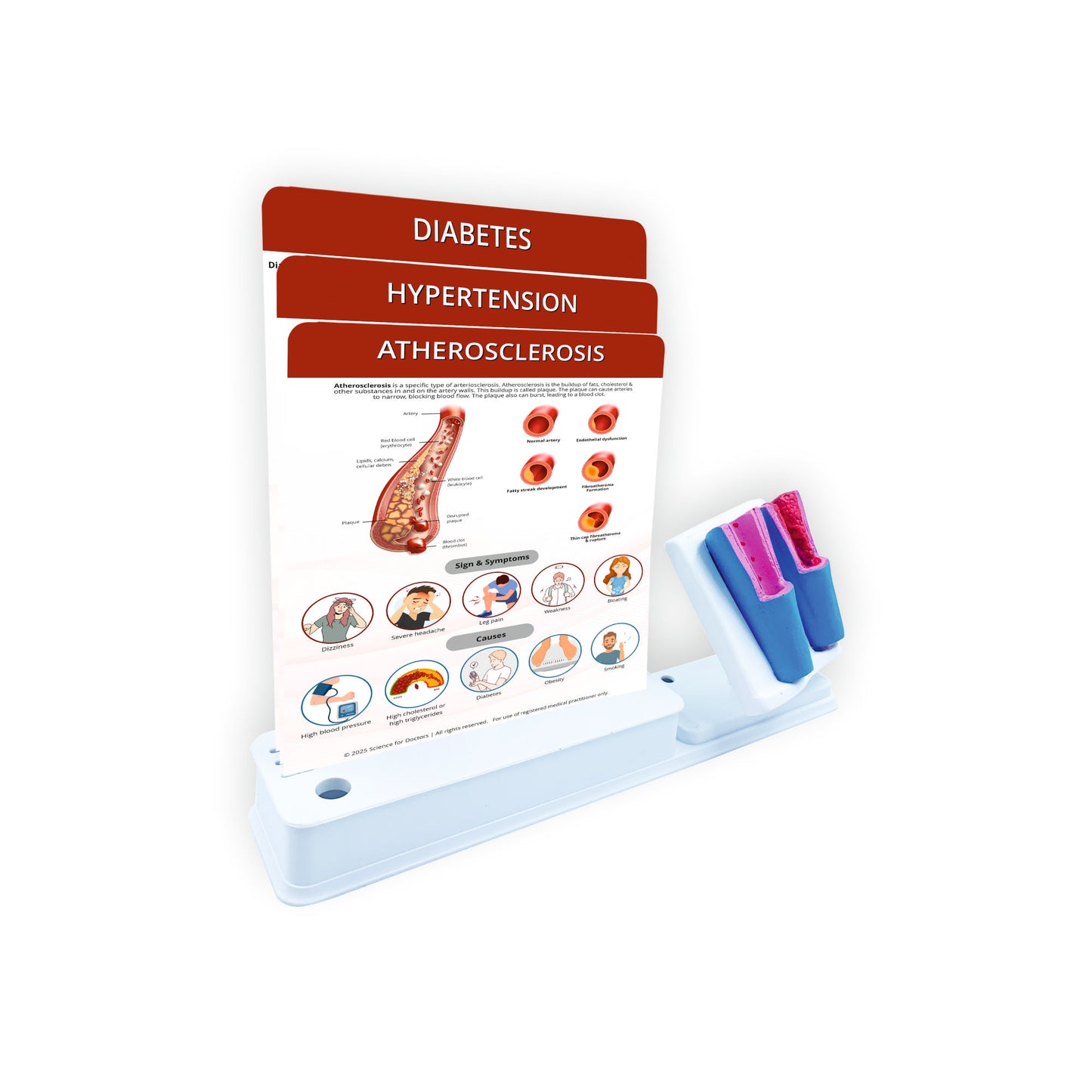 Atherosclerosis: Smart -3 Slides Write & Wipe With Anatomical Model
