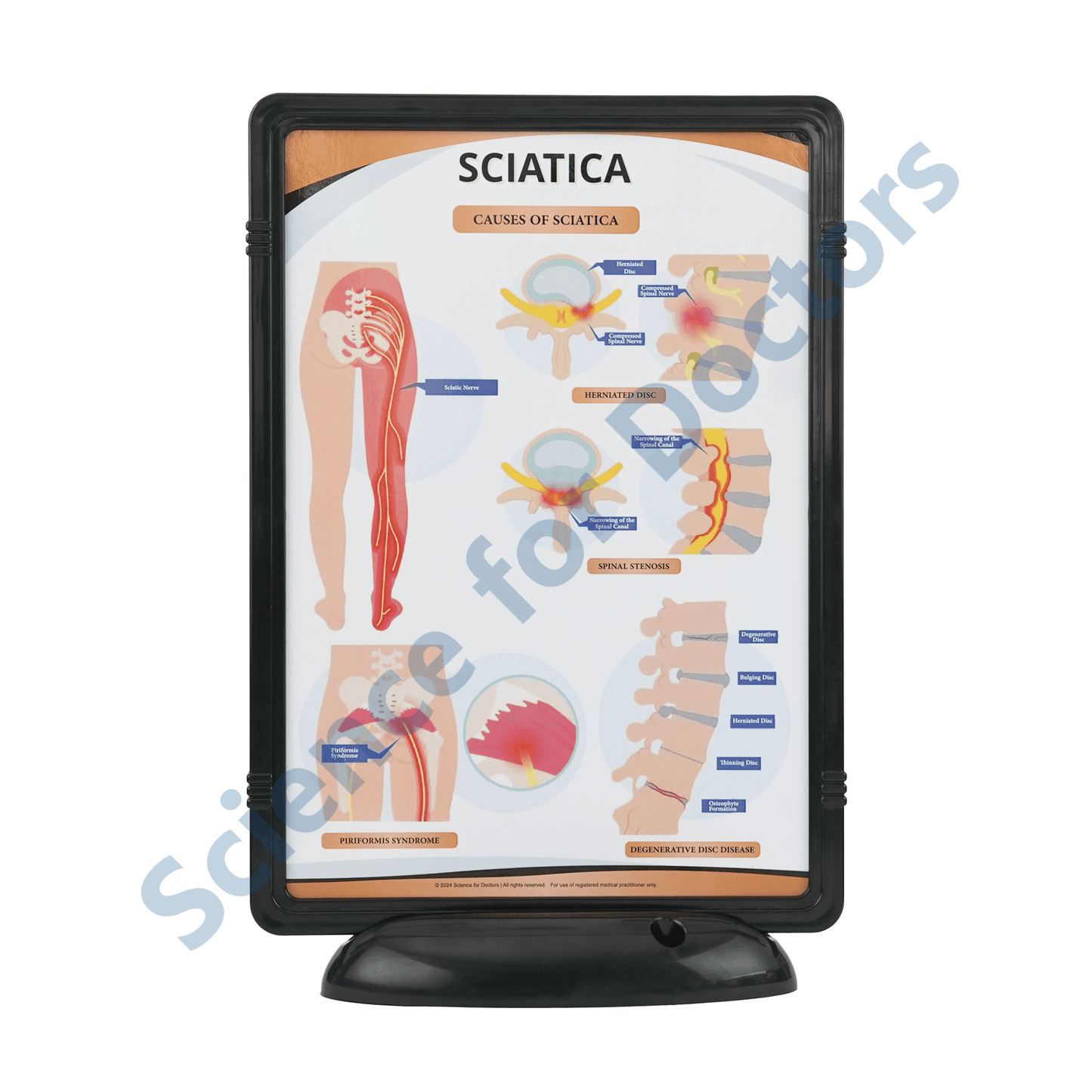 Sciatica: The Frame Write and Wipe