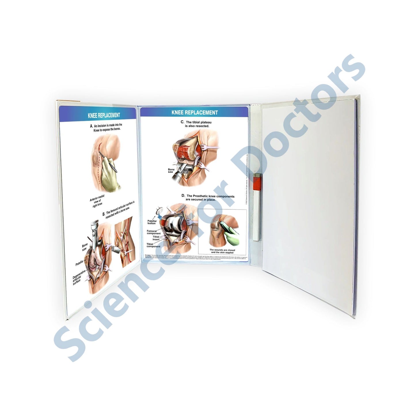 Three Fold Book Write & Wipe : STAGES OF OSTEOARTHRITIS(KNEE)