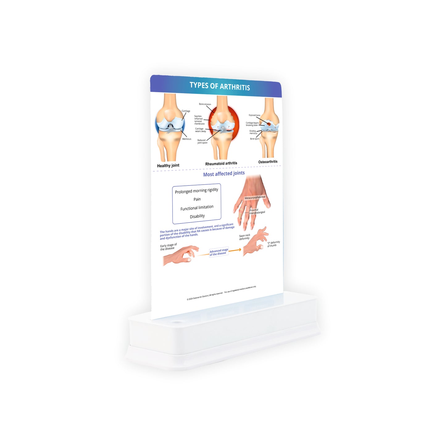 Types of Arthritis: 1 Slide on stand