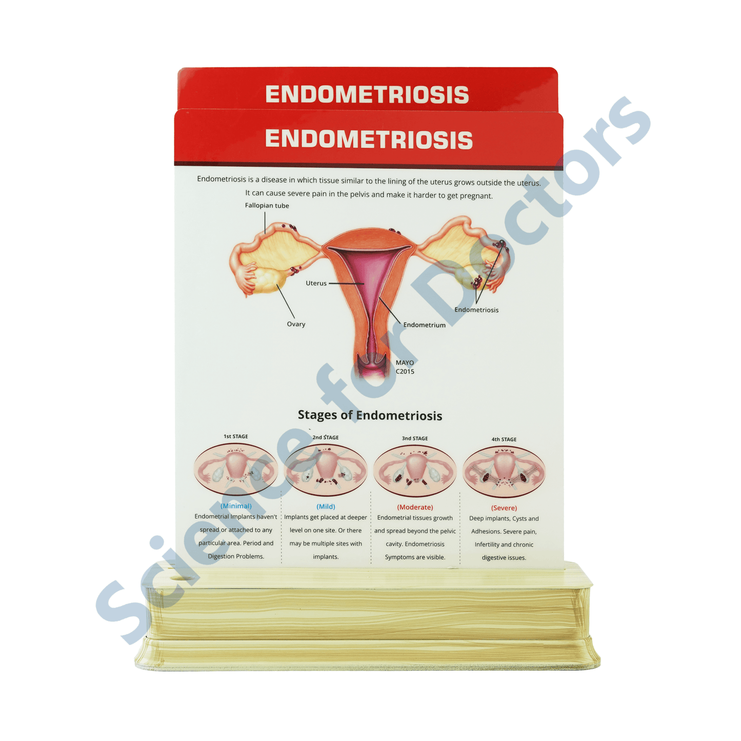 Endometriosis (1): 2 Slide on stand