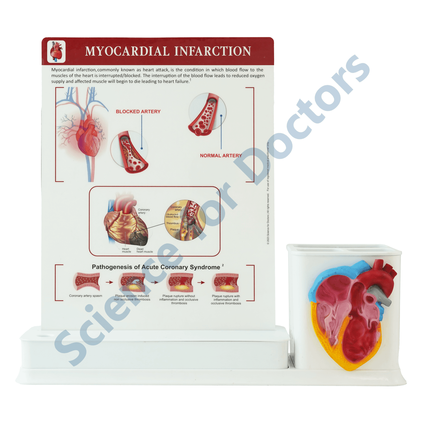 Myocardial Infraction : 1 Slide Write and wipe with anatomical model on stationery stand