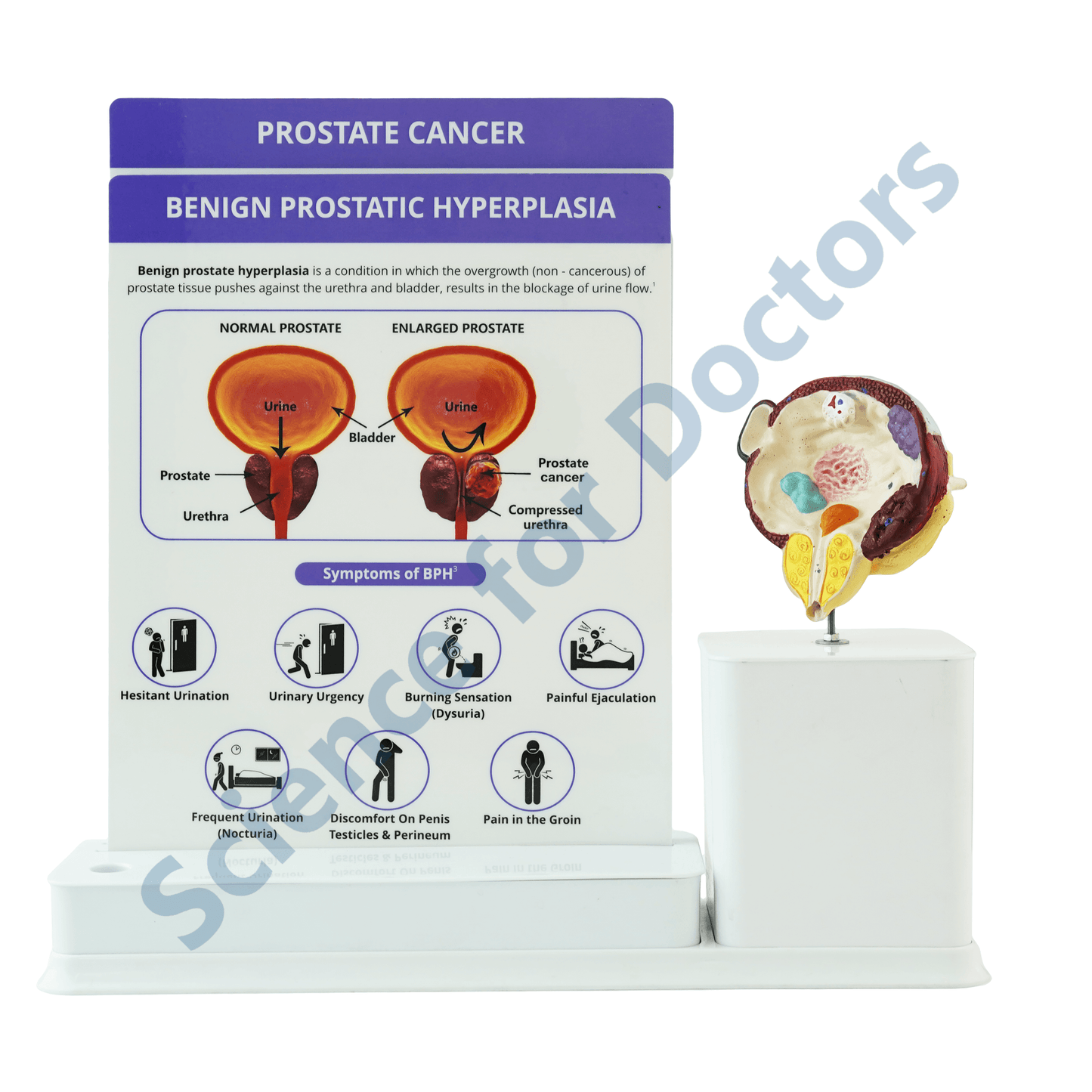 Prostate Cancer : 2 slide Write and Wipe with Anatomical Model