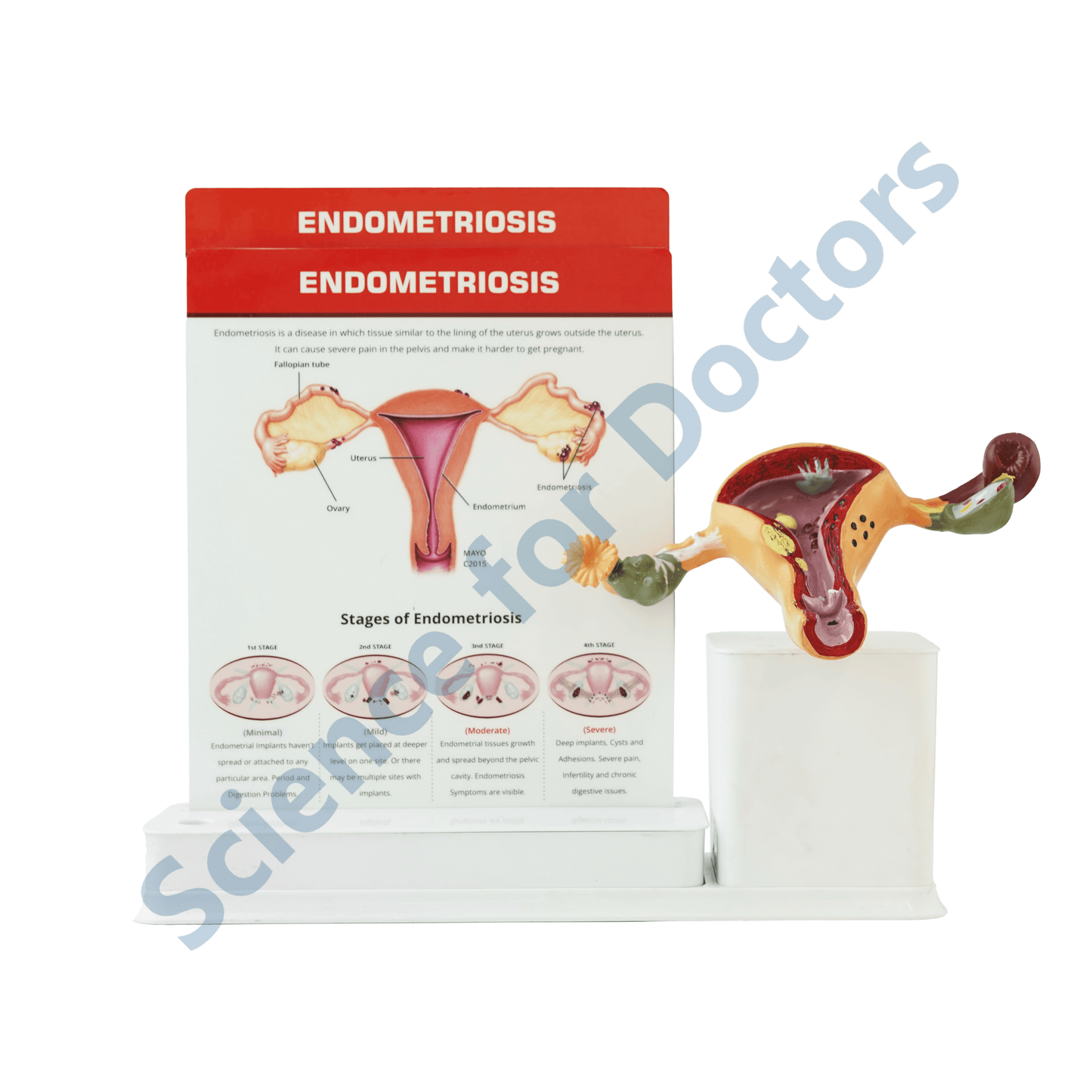 Endometriosis : 2 slide Write and Wipe with Anatomical Model