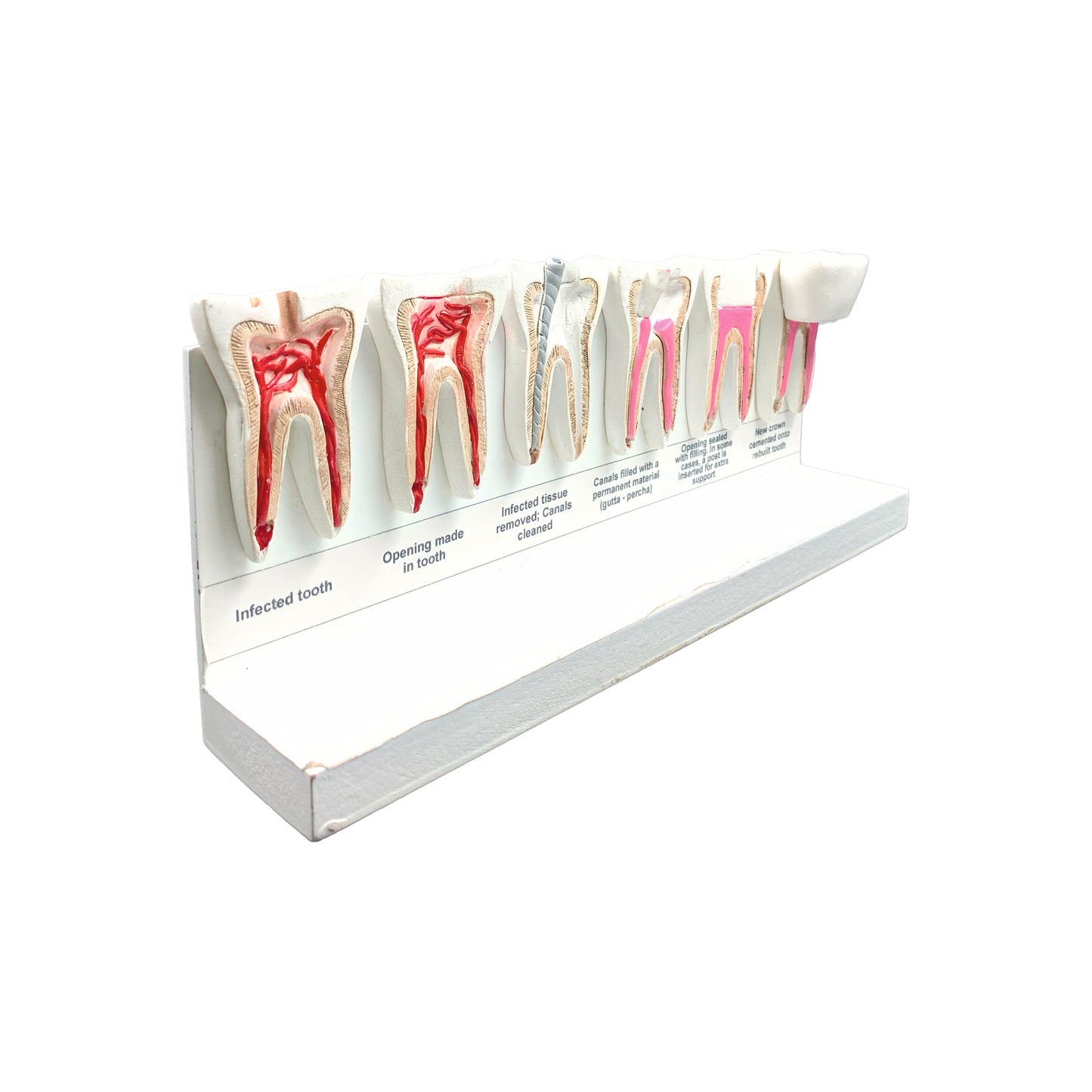 Stages of Root Canal: 3D Anatomical Models