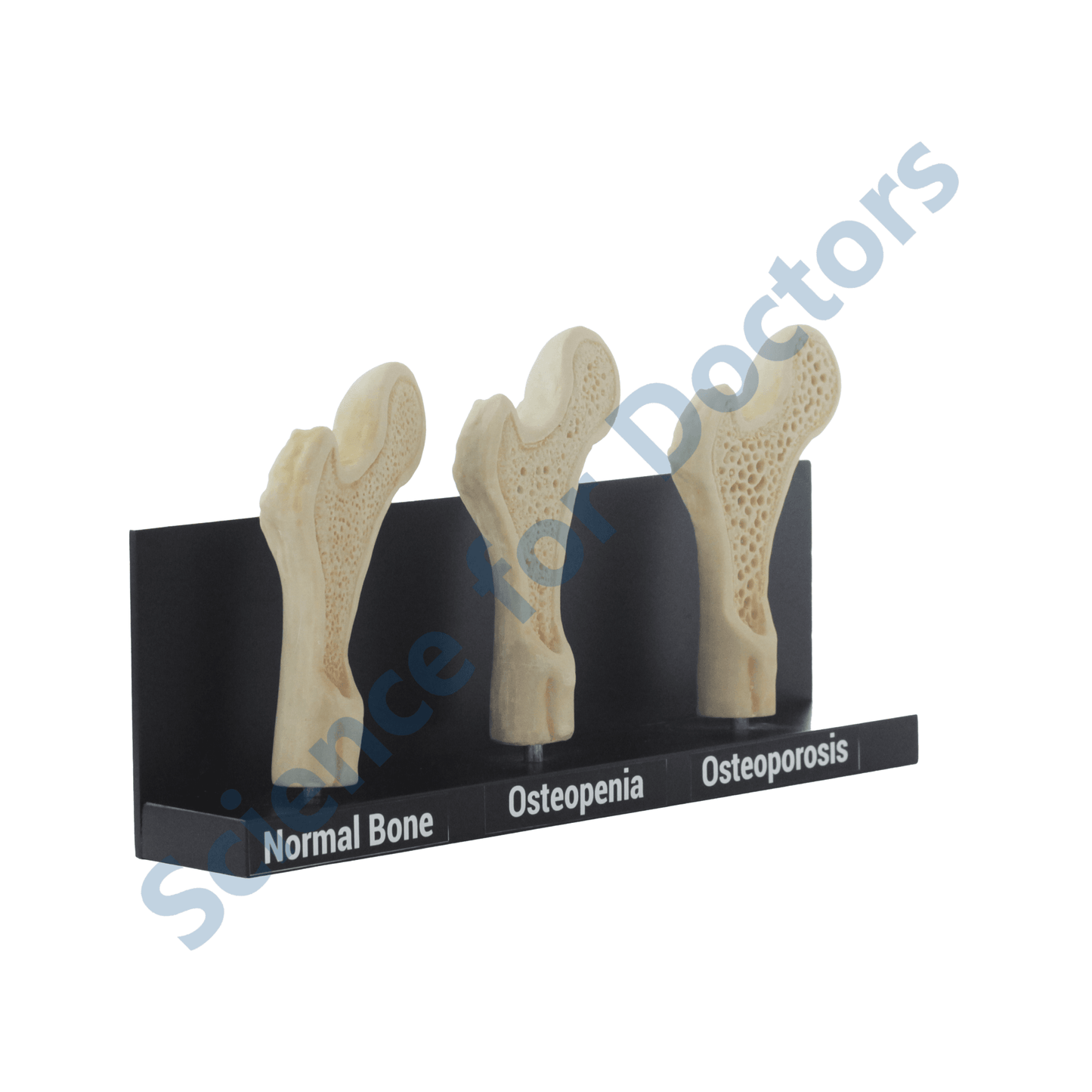 Osteoporosis: 3D Anatomical Models