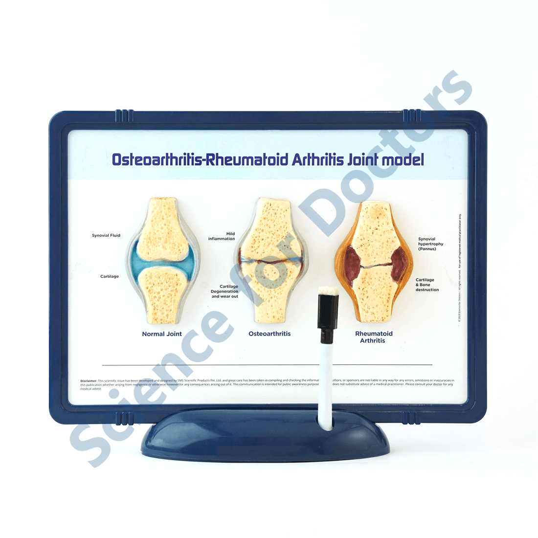 Osteoarthritis-Rheumatoid Arthritis Joint: 3D Therapy Frame