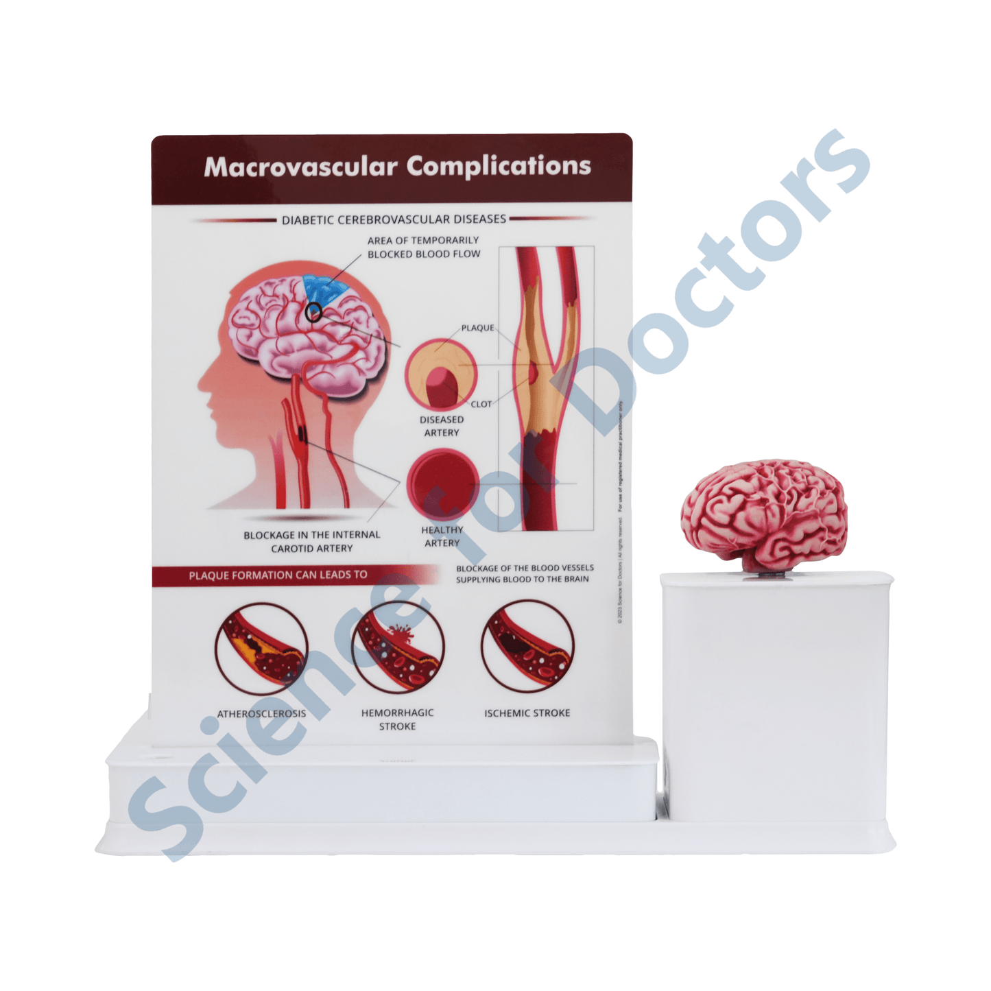 Macrovascular Complications Diabetic Cerebrovascular Diseases : 1 Slide write and wipe with anatomical model on stand