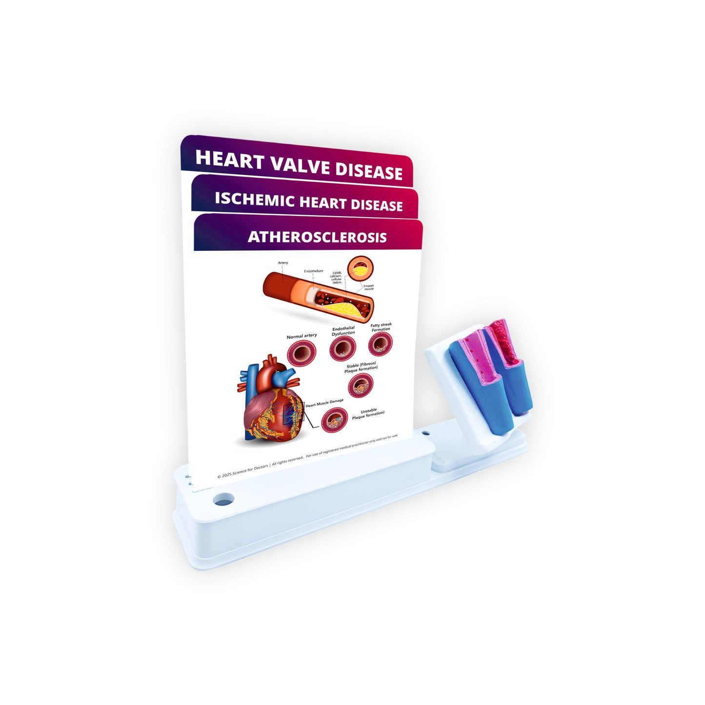 Atherosclerosis: Smart -3 Slides Write & Wipe With Anatomical Model