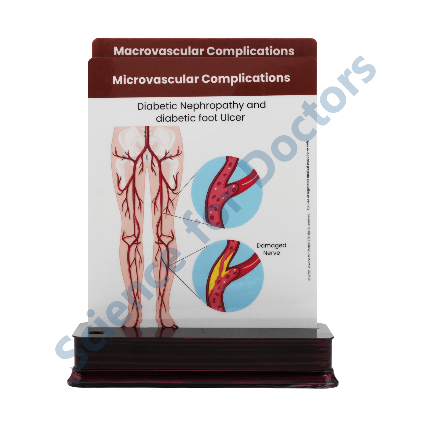 Microvascular Complications: 2 Slide on stand