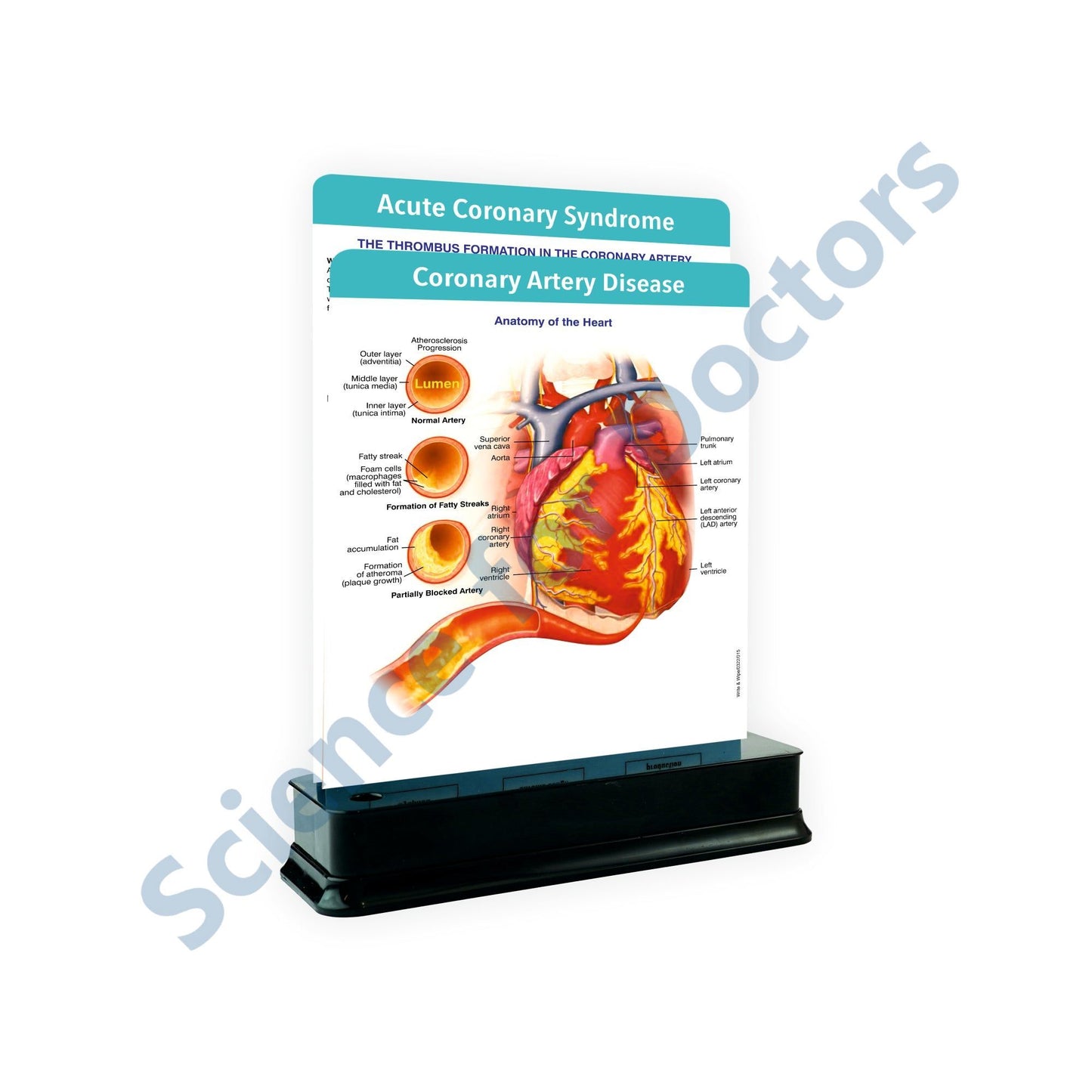 Coronary Artery Disease: 2 Slides with Stand