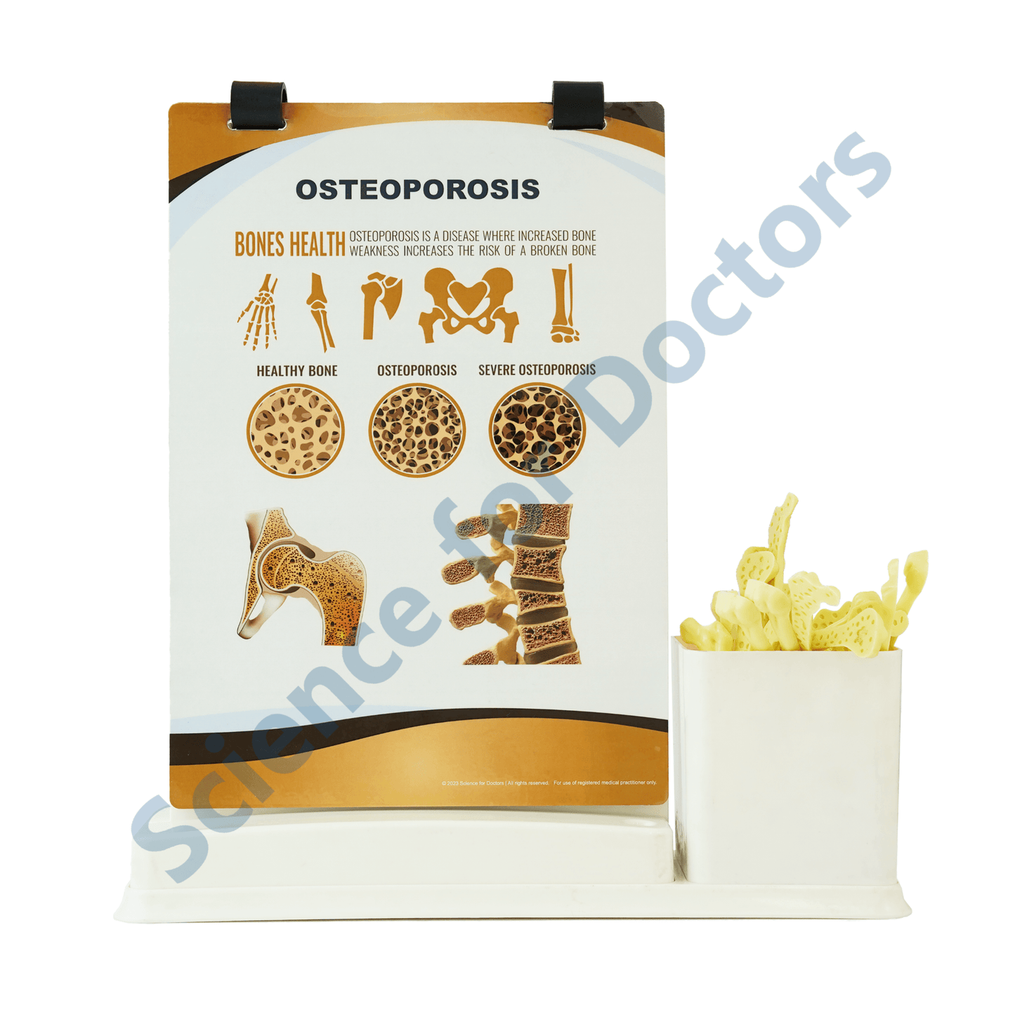 Osteoporosis: A4 Flip Wipe With Anatomical Model