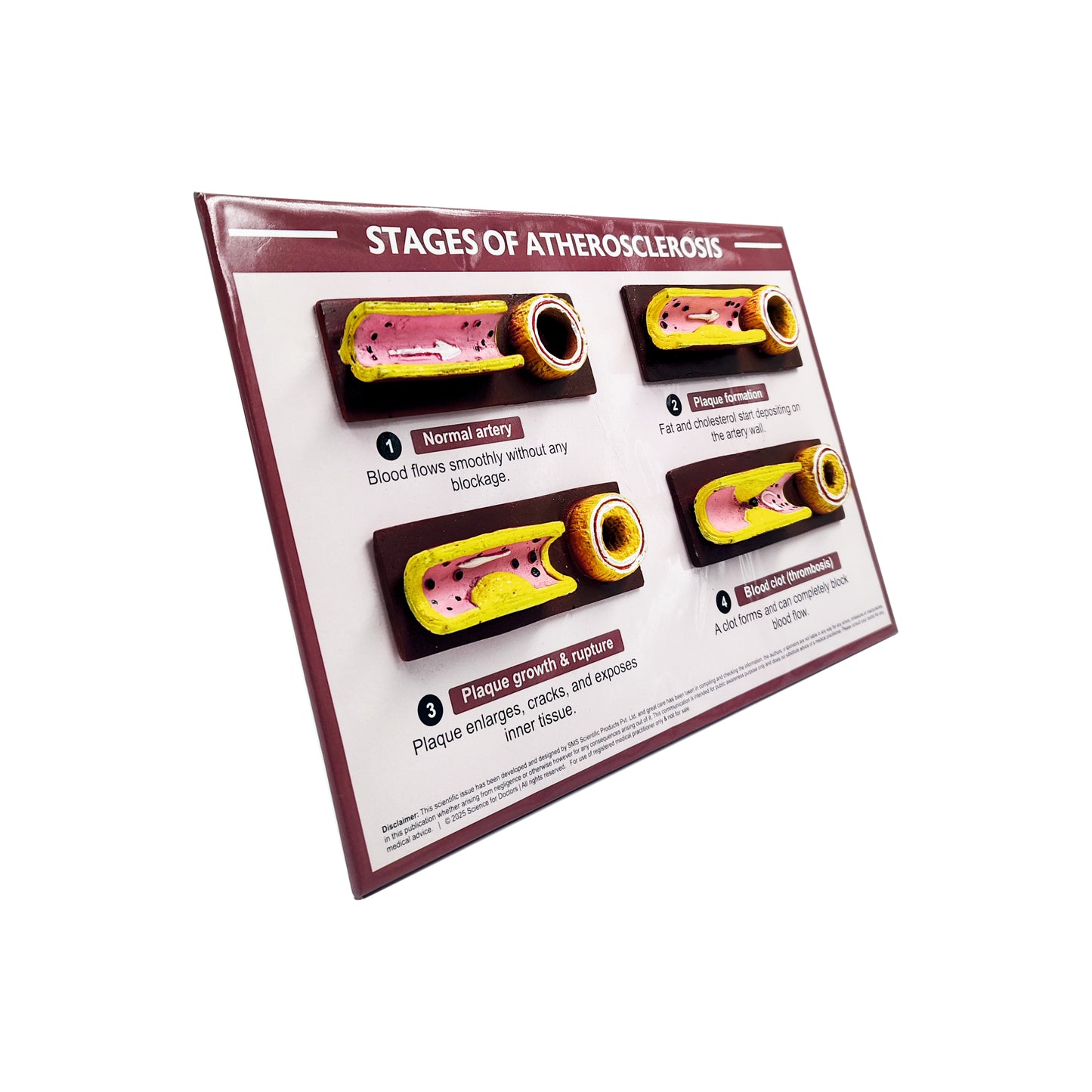 3D Therapy Board - Stages of Atherosclerosis