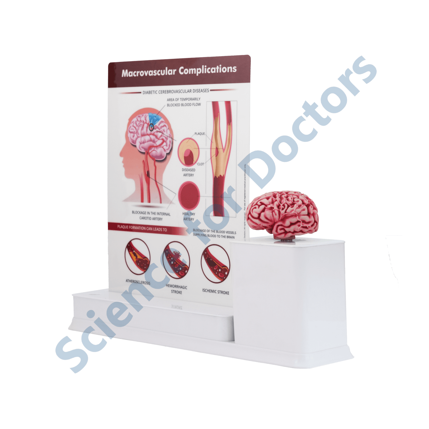 Macrovascular Complications Diabetic Cerebrovascular Diseases : 1 Slide write and wipe with anatomical model on stand