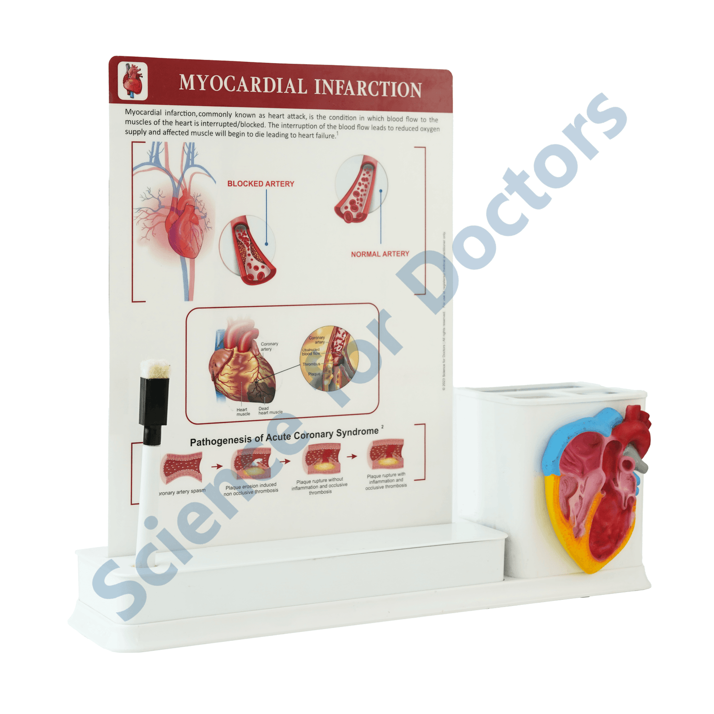 Myocardial Infraction : 1 Slide Write and wipe with anatomical model on stationery stand