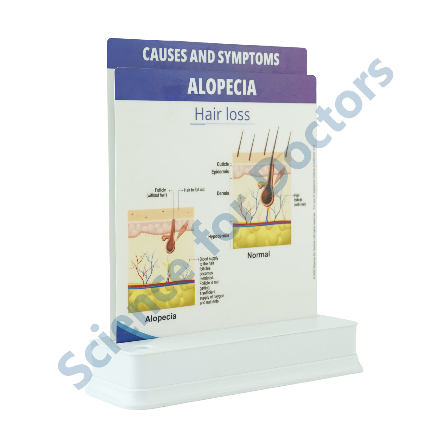 Alopecia: 2 slide on stand