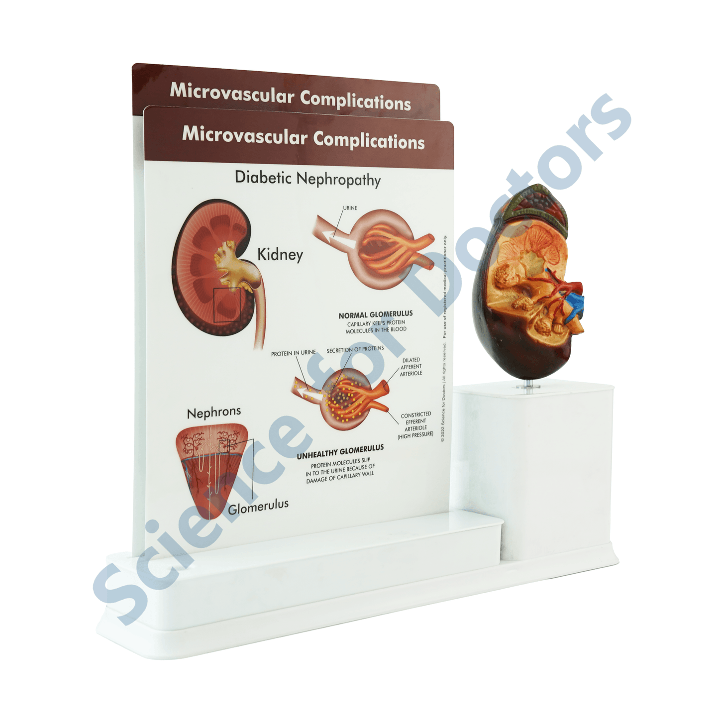 Microvascular Complications  : 2 slide Write and Wipe with Anatomical Model