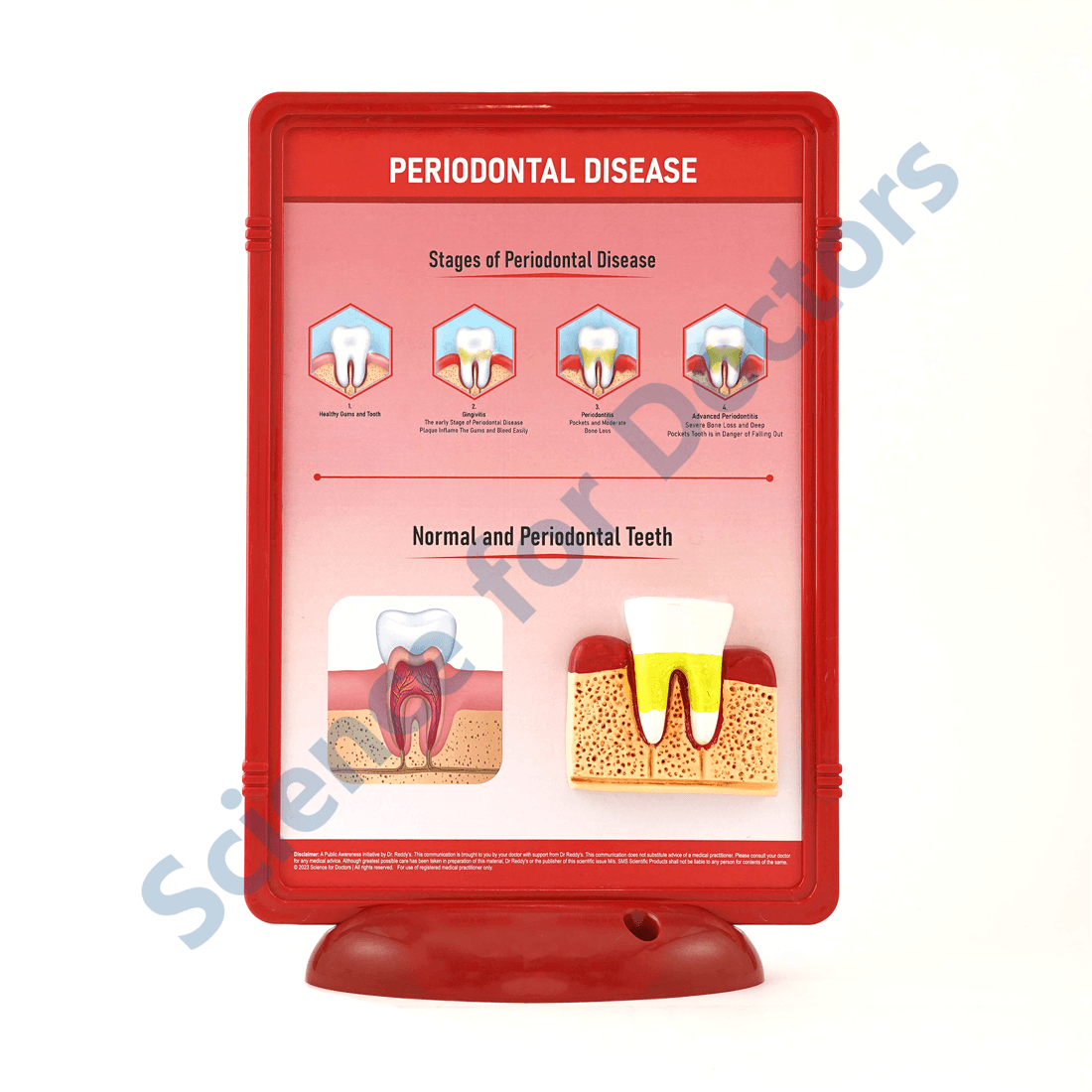 Periodontal Disease: 3D Therapy Frame