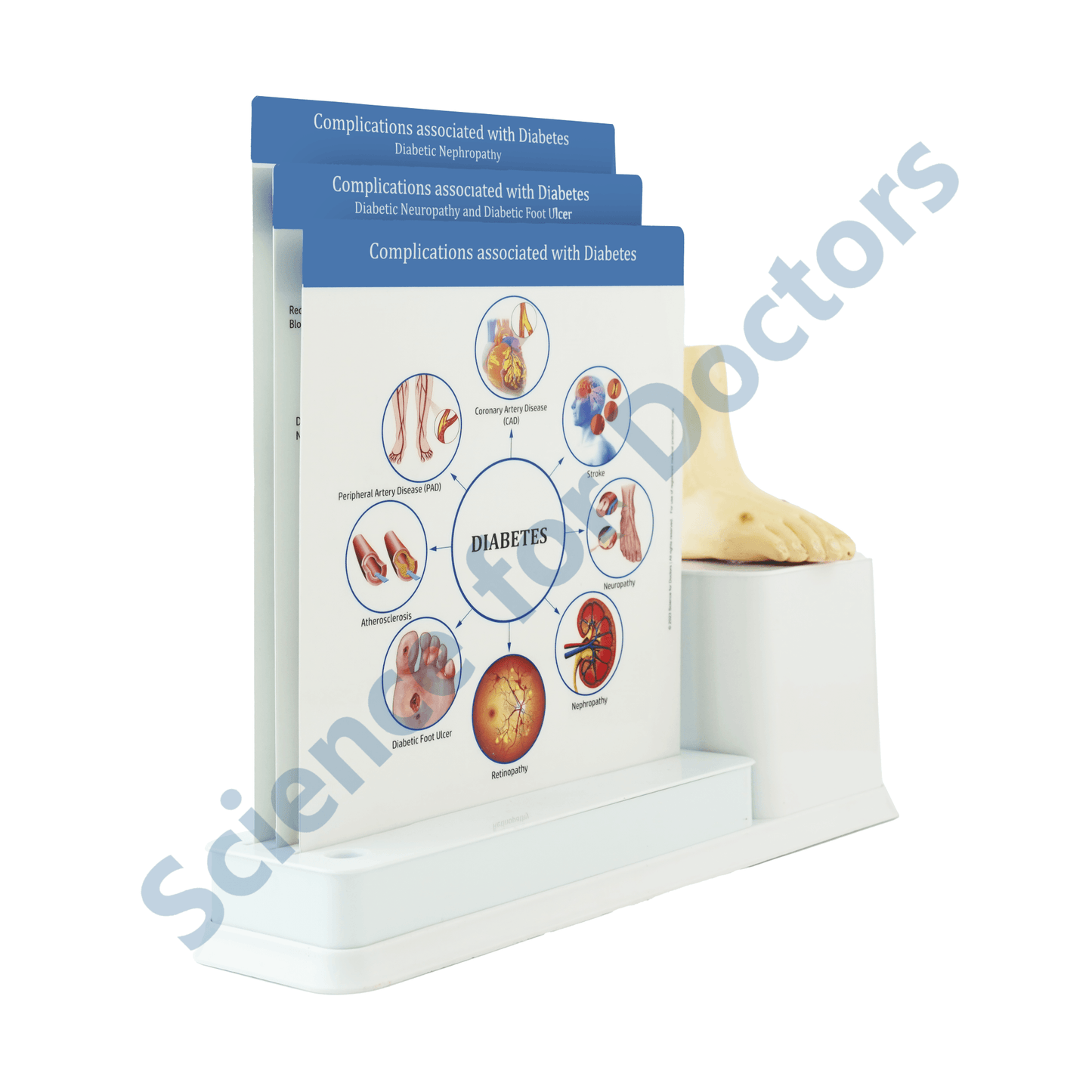 Diabetes Complication : 3 Slide Write and Wipe with Anatomical Model on Stand