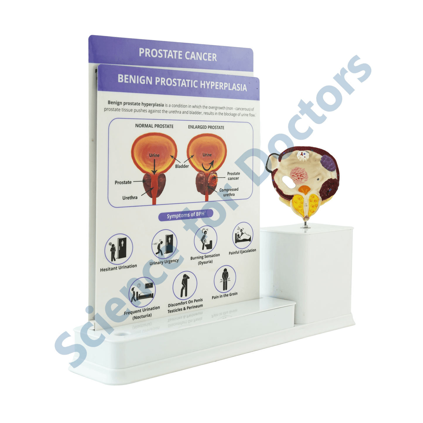 Prostate Cancer : 2 slide Write and Wipe with Anatomical Model