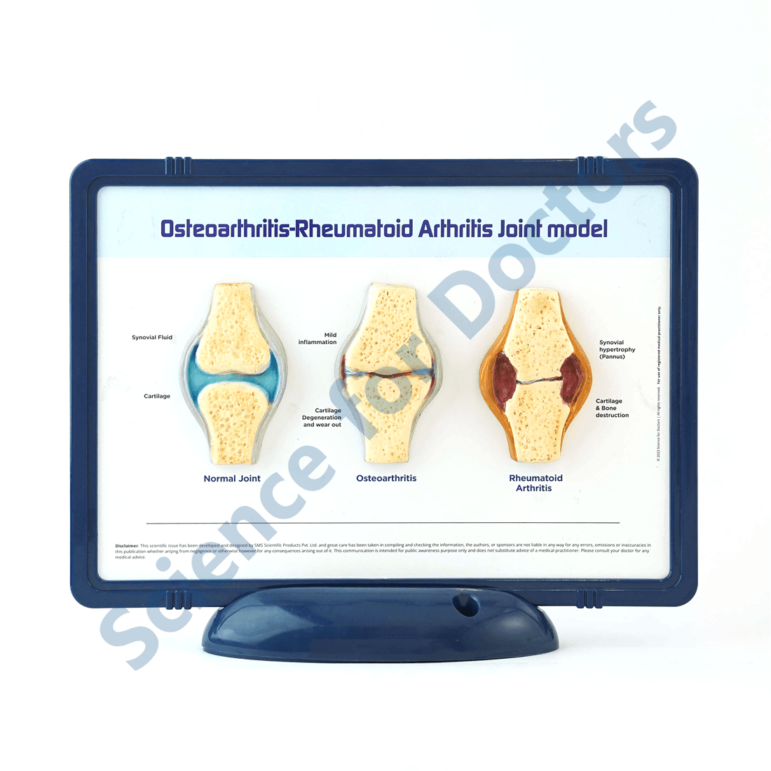 Osteoarthritis-Rheumatoid Arthritis Joint: 3D Therapy Frame