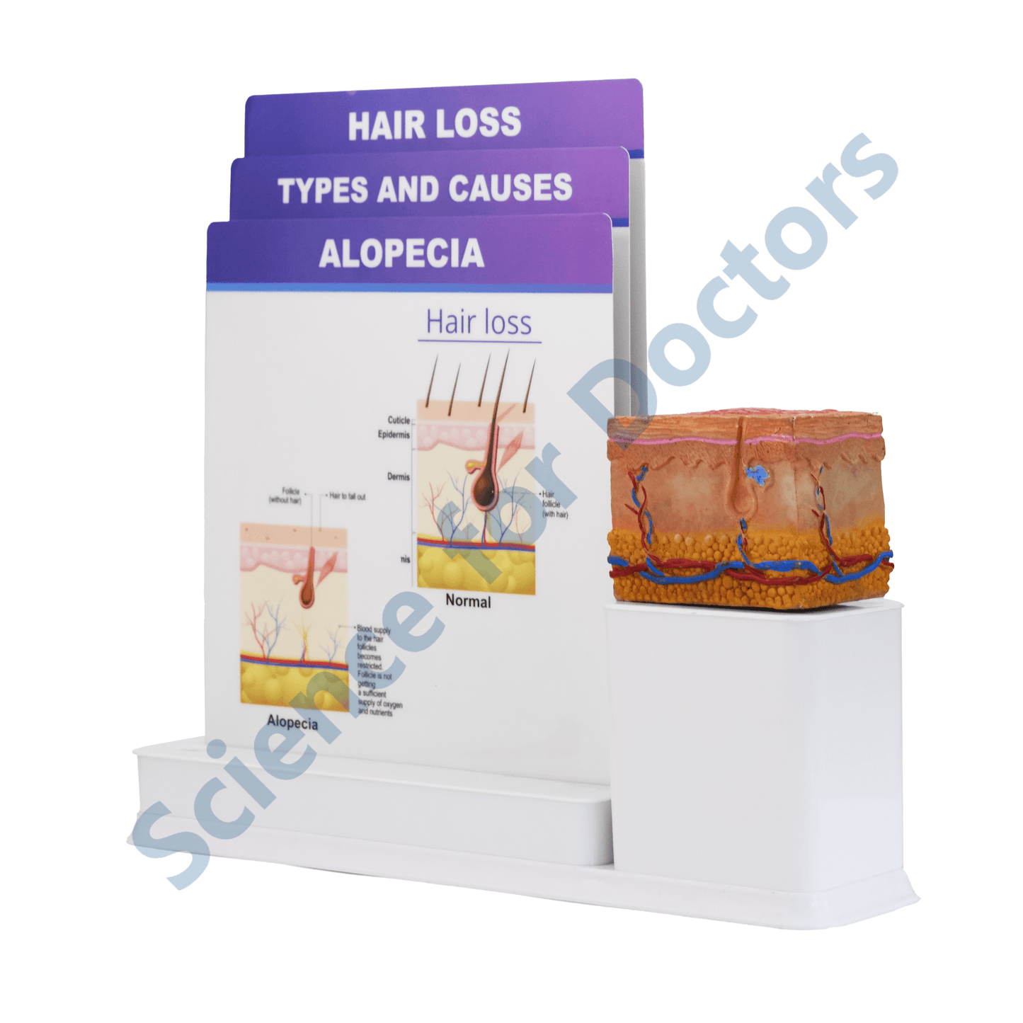 Alopecia: 3 Slide Write and Wipe with Anatomical Model on Stand