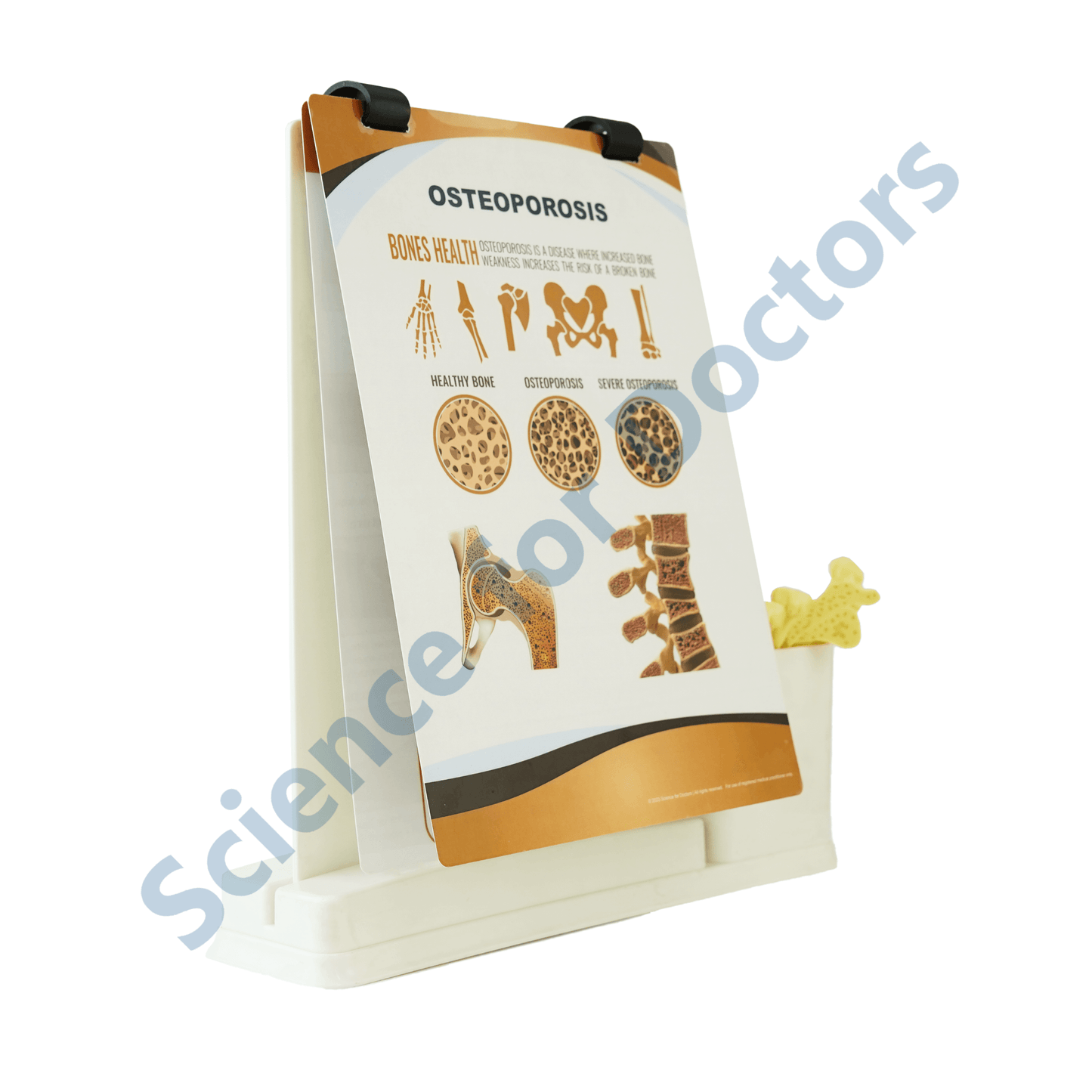 Osteoporosis: A4 Flip Wipe With Anatomical Model