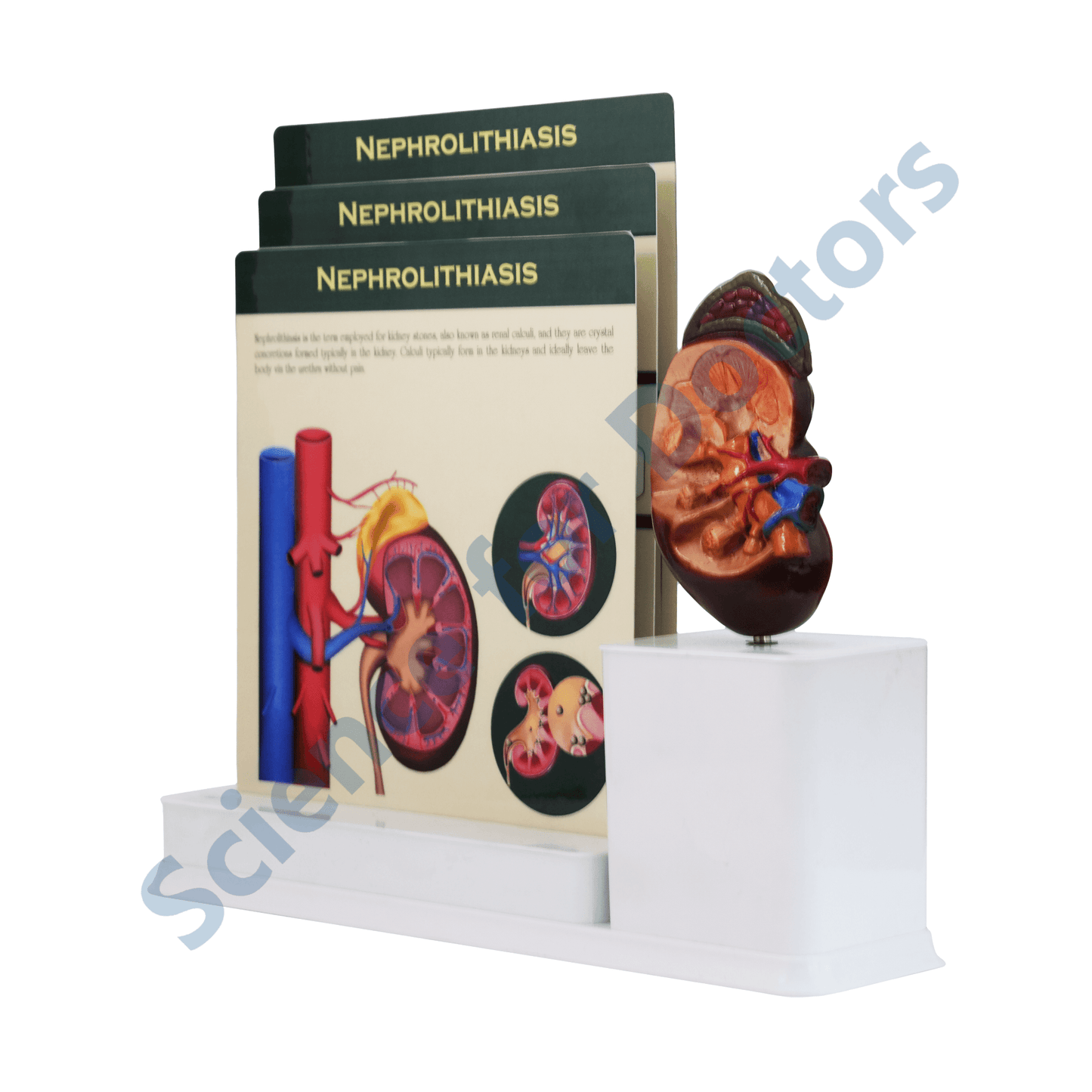 Nephrolithiasis : 3 Slide Write and Wipe with Anatomical Model on Stand