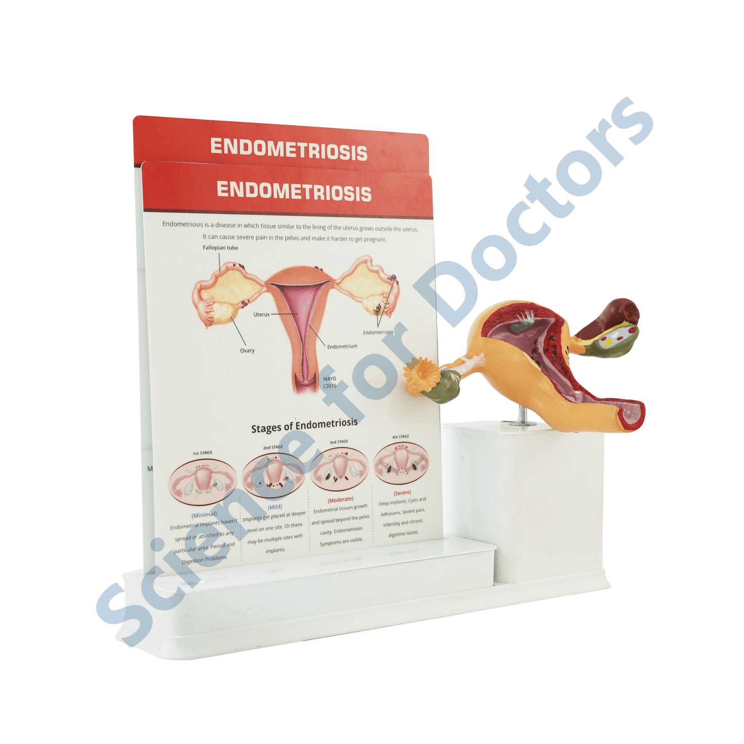 Endometriosis : 2 slide Write and Wipe with Anatomical Model