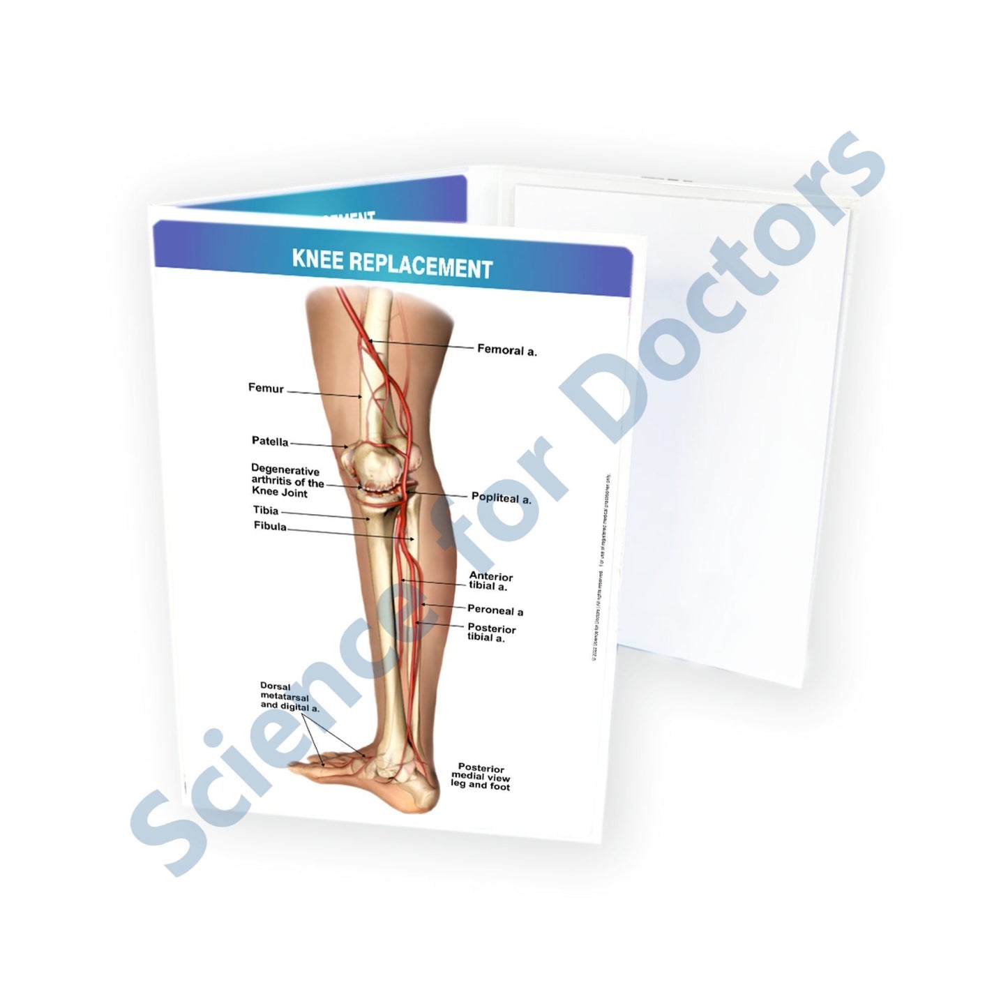 Three Fold Book Write & Wipe : STAGES OF OSTEOARTHRITIS(KNEE)