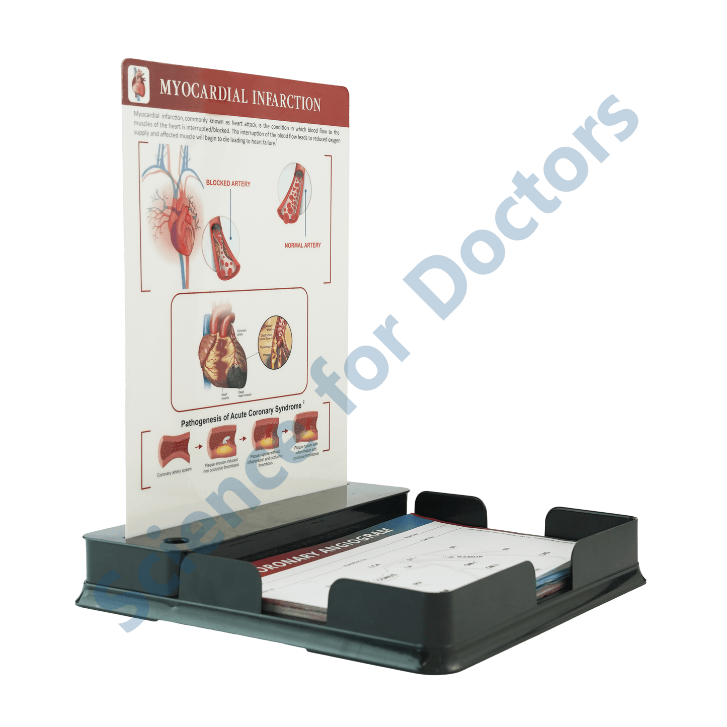 Myocardial infarction: One slide with Tray