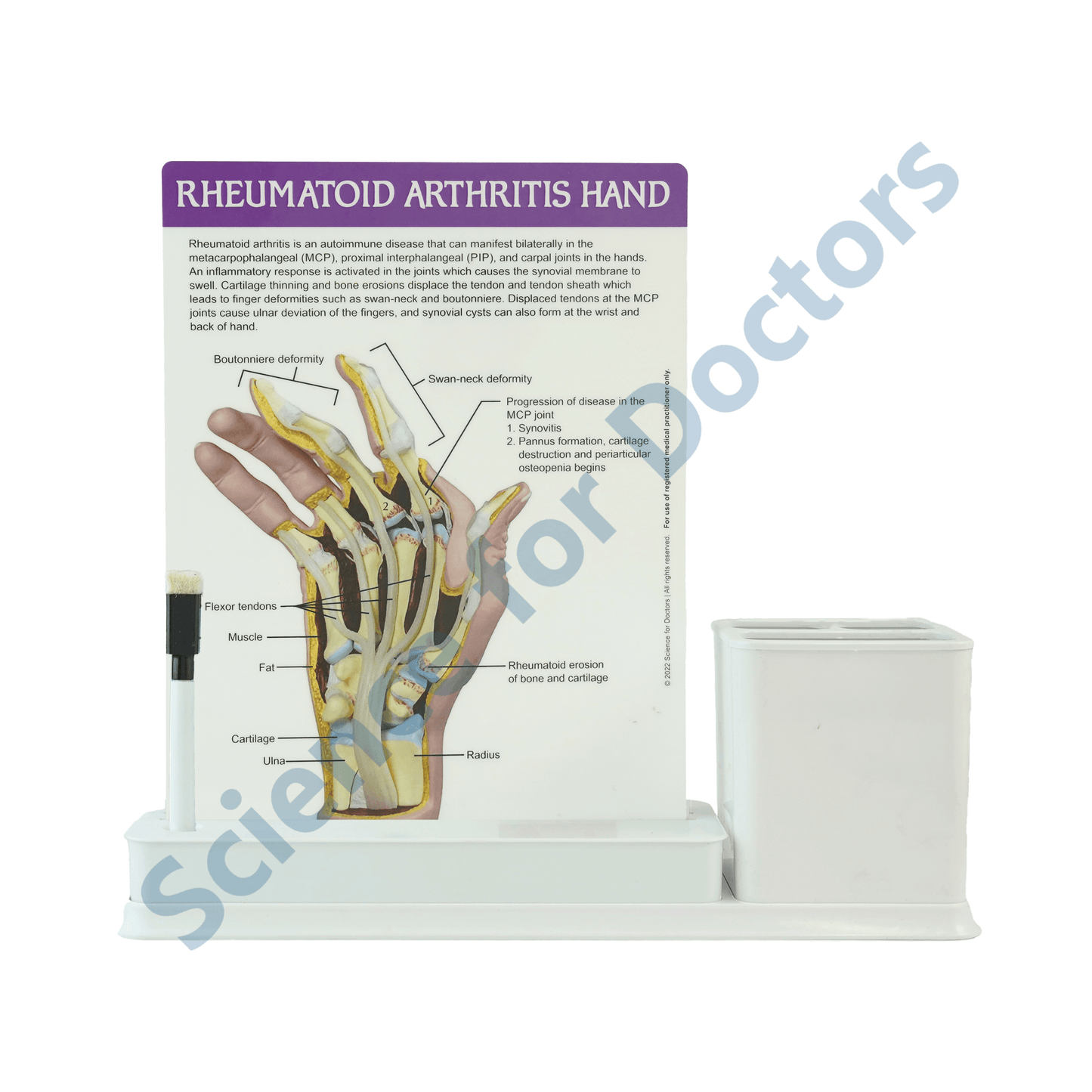 Rheumatoid Arthritis Hand: 1 Slides Write & Wipe with Stationary Stand