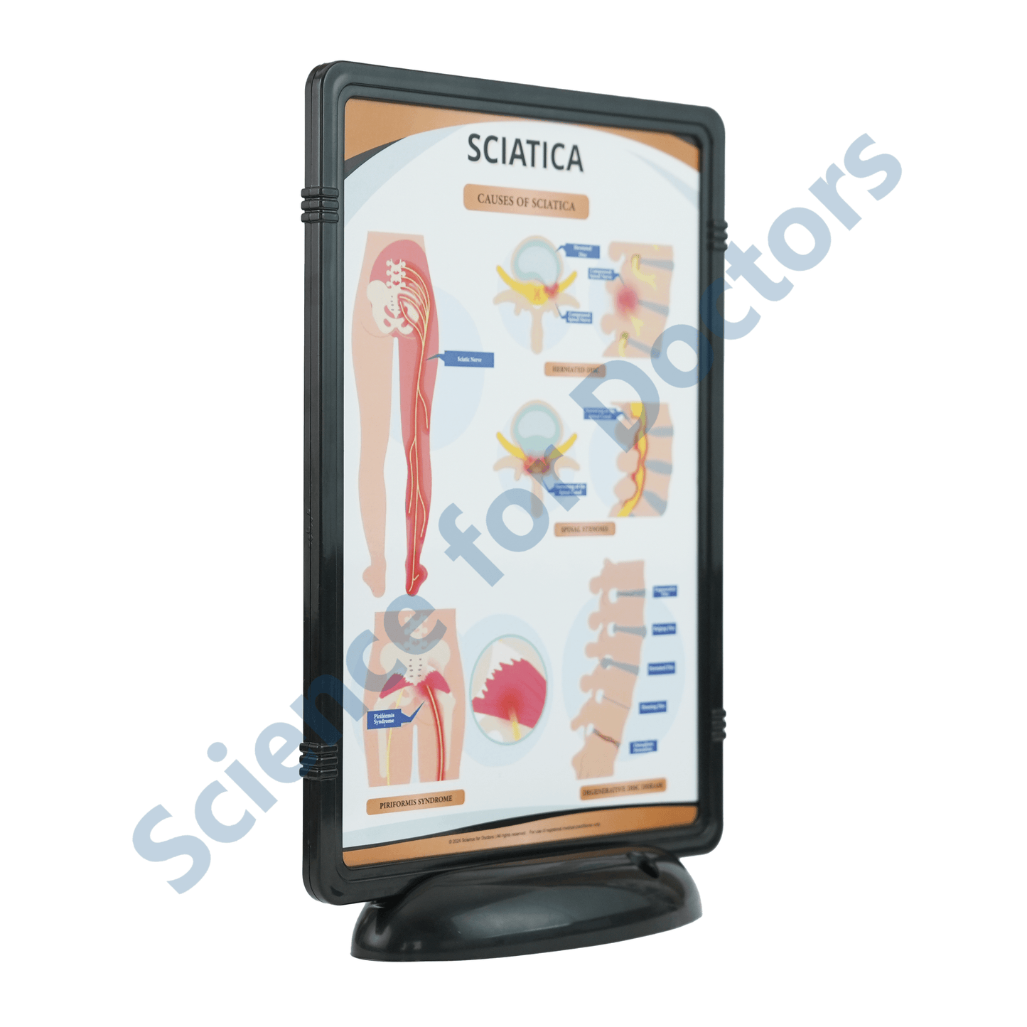 Sciatica: The Frame Write and Wipe