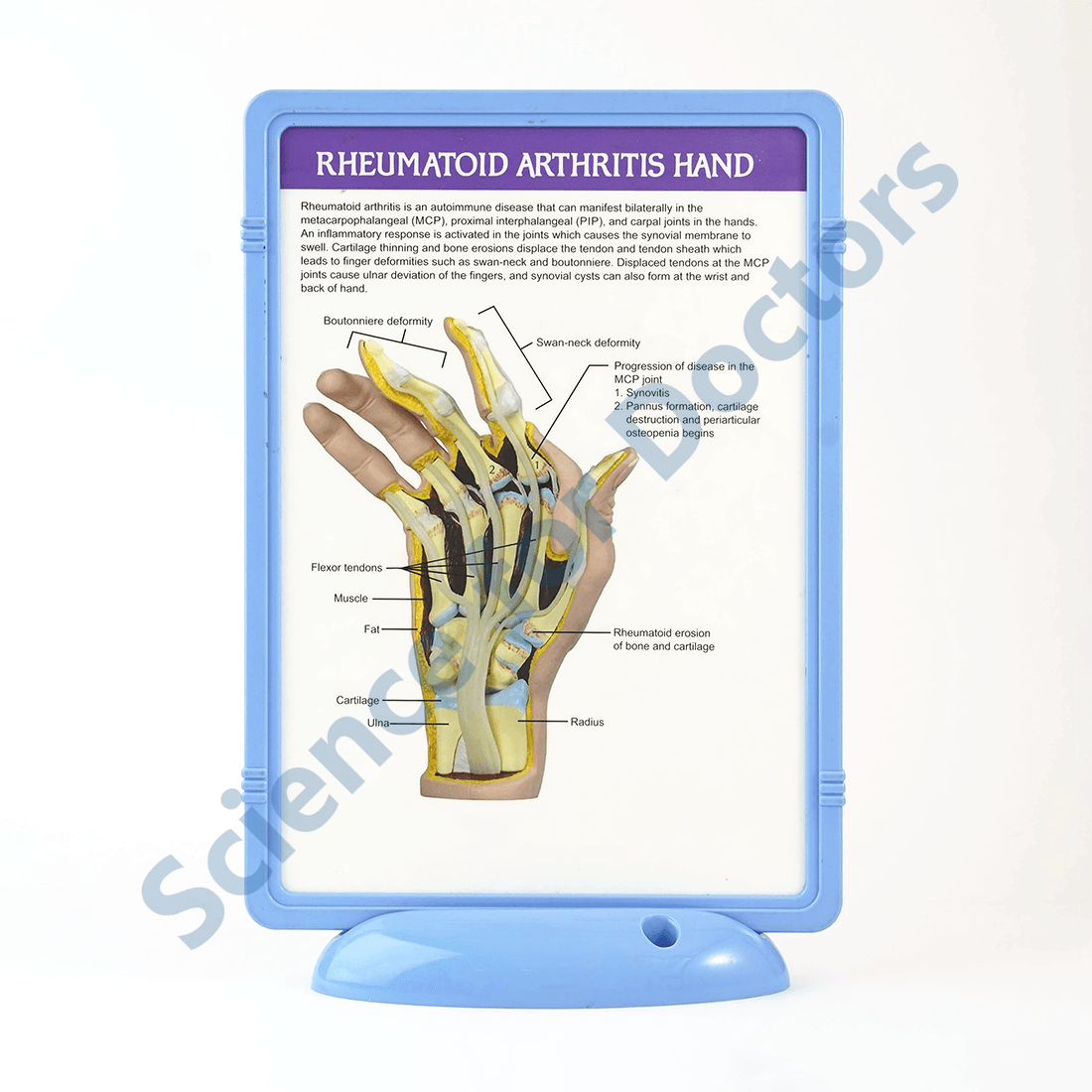 Rheumatoid Arthritis Hand: The Frame Write and Wipe