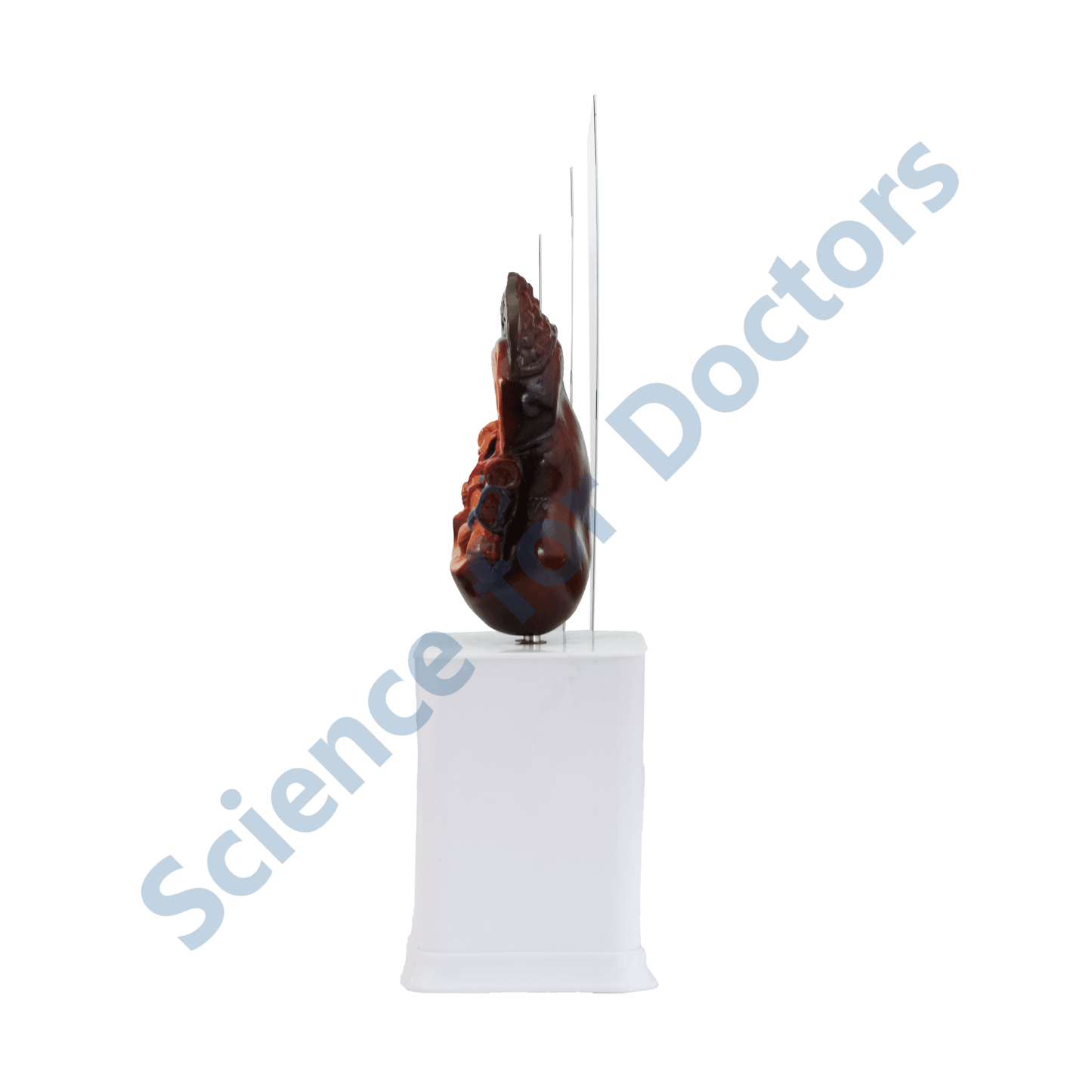 Nephrolithiasis : 3 Slide Write and Wipe with Anatomical Model on Stand