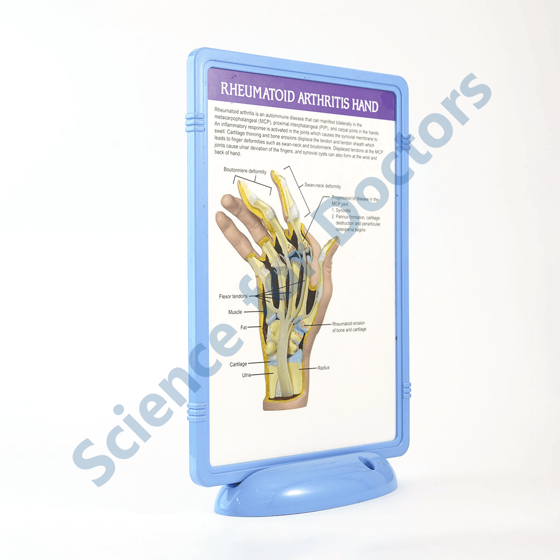 Rheumatoid Arthritis Hand: The Frame Write and Wipe