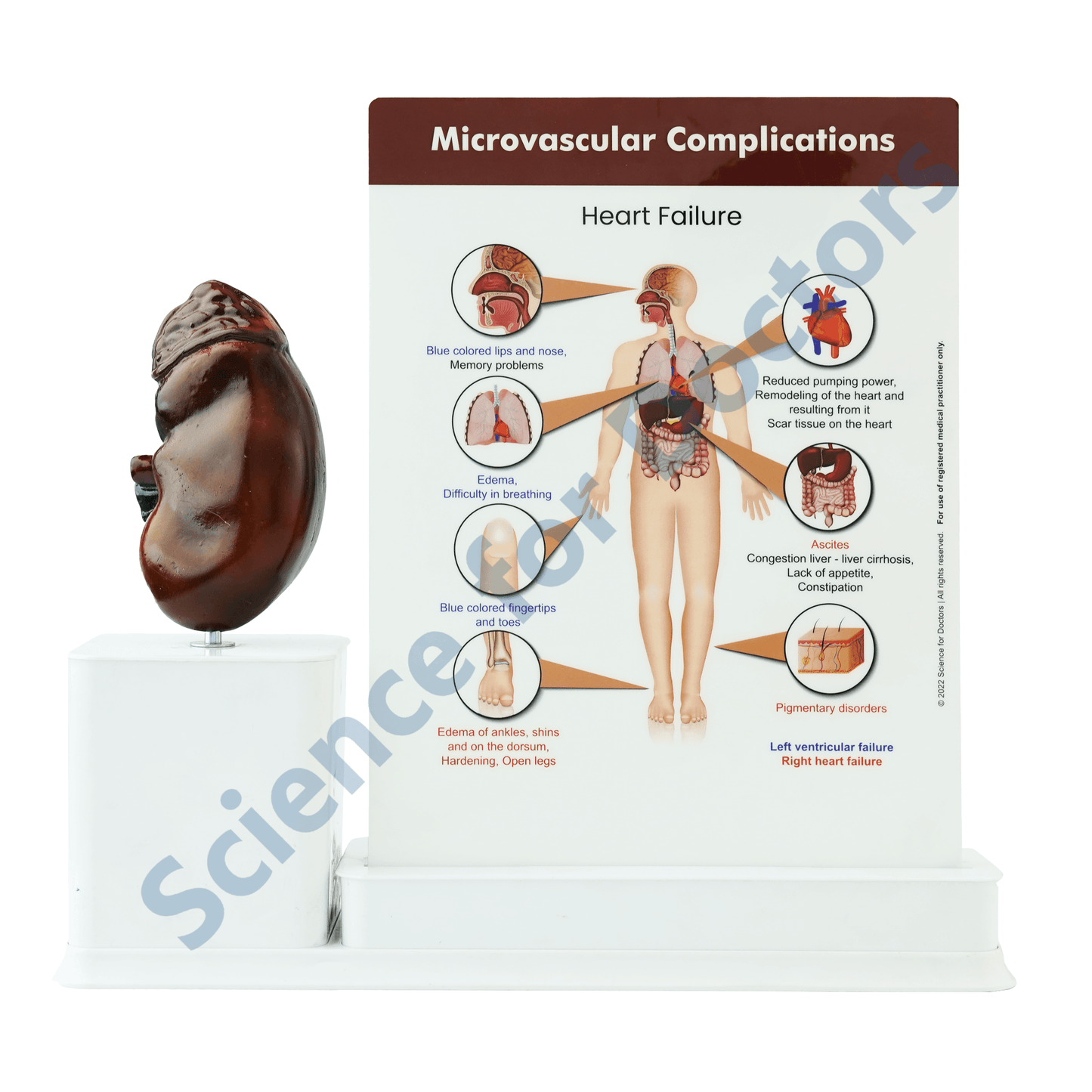 Microvascular Complications  : 2 slide Write and Wipe with Anatomical Model