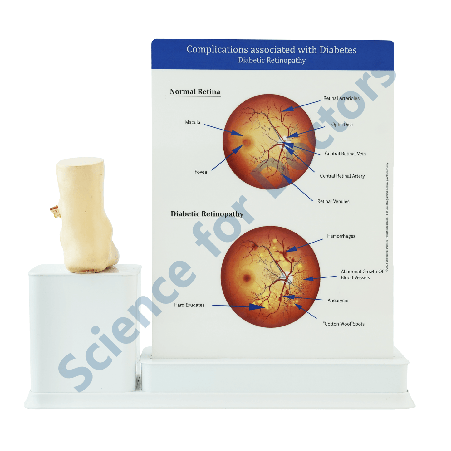 Diabetes Complication : 3 Slide Write and Wipe with Anatomical Model on Stand