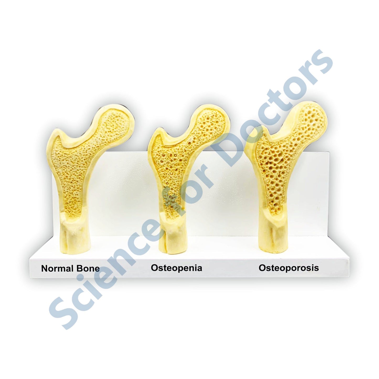 Osteoporosis: 3D Anatomical Models